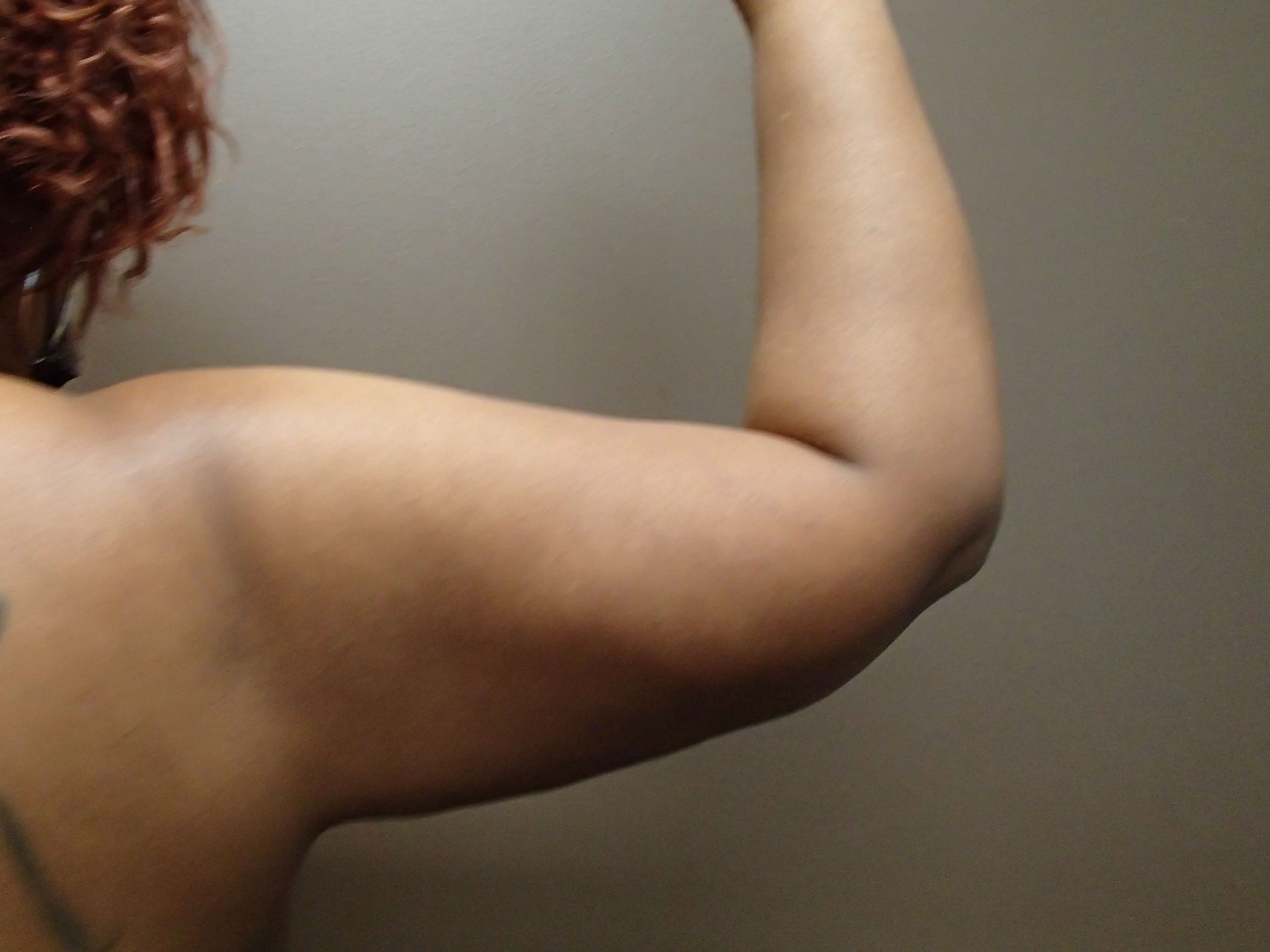 Liposuction After