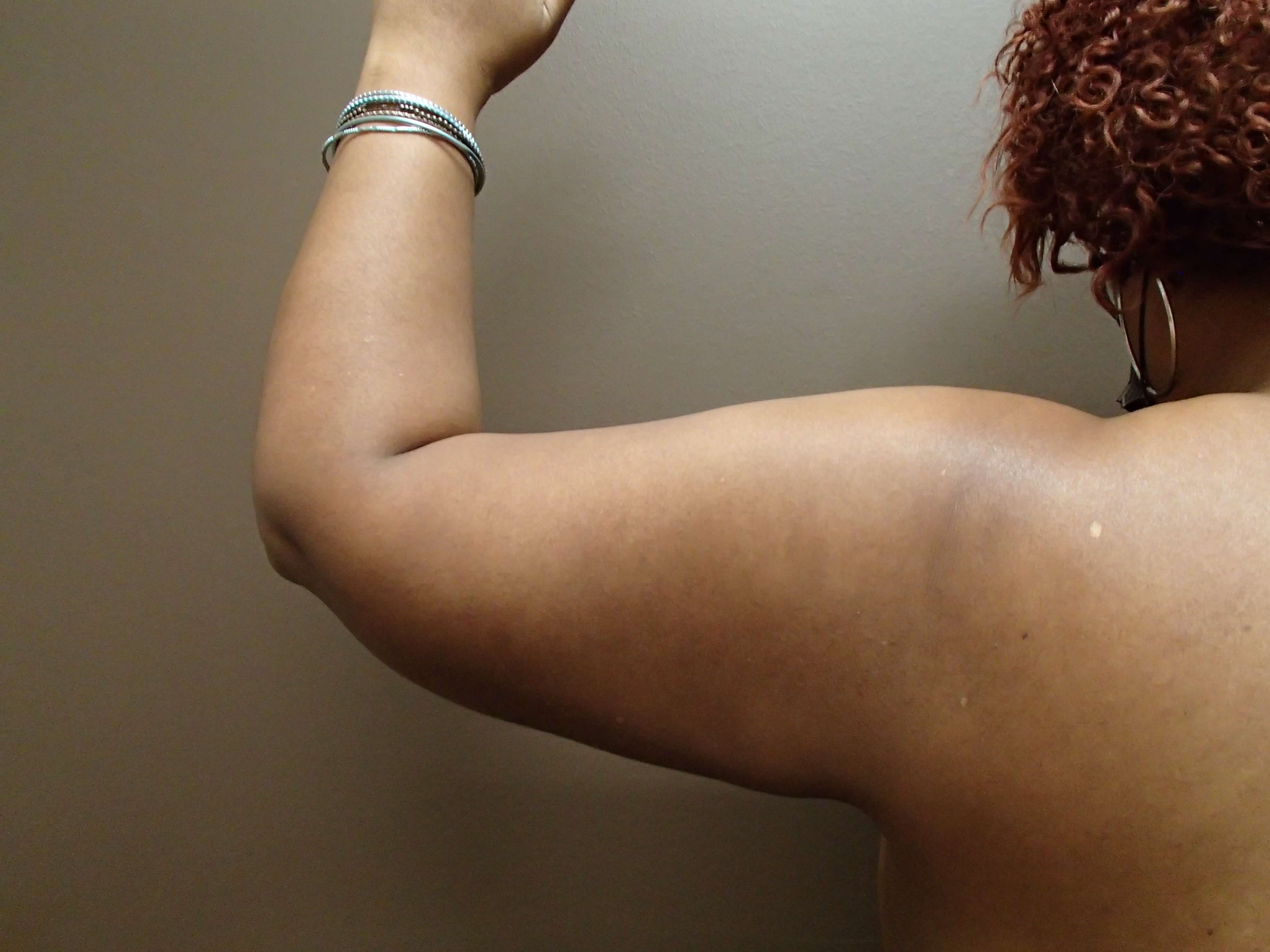 Liposuction After