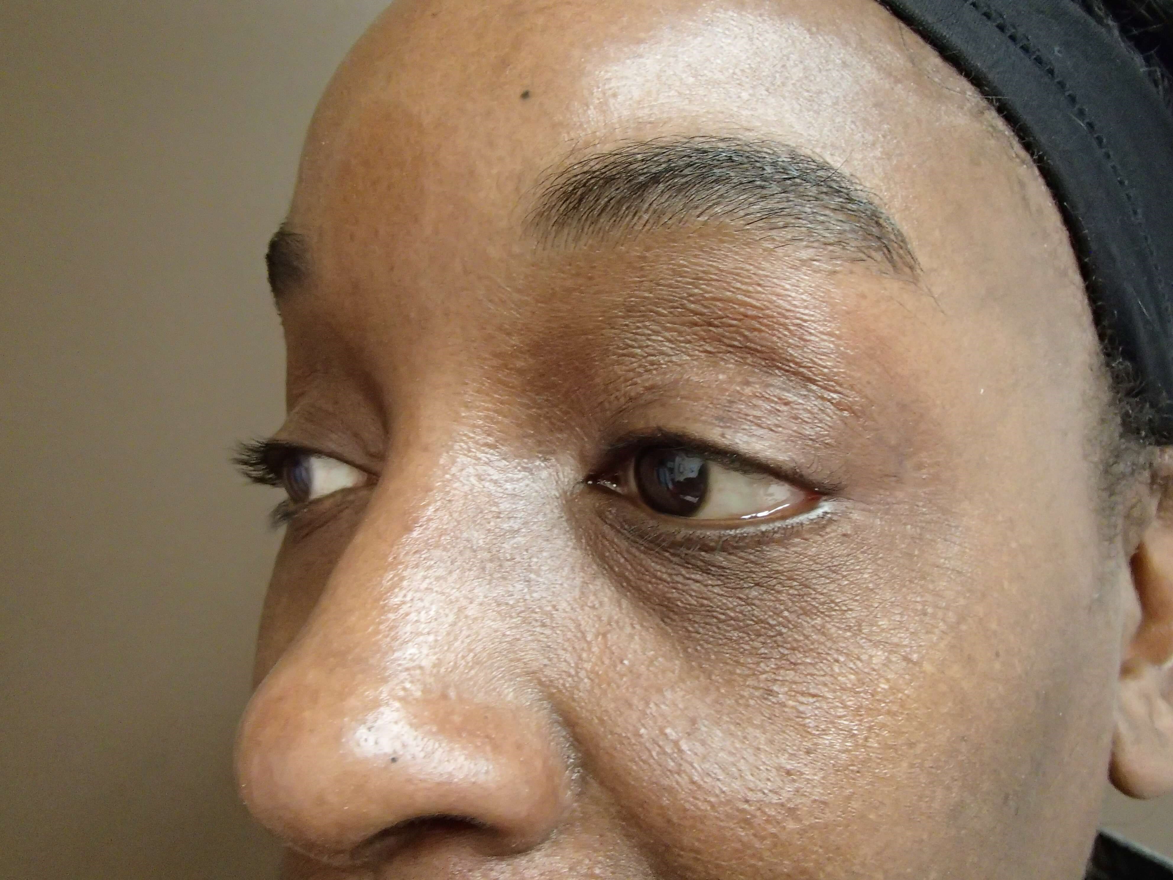 Blepharoplasty After