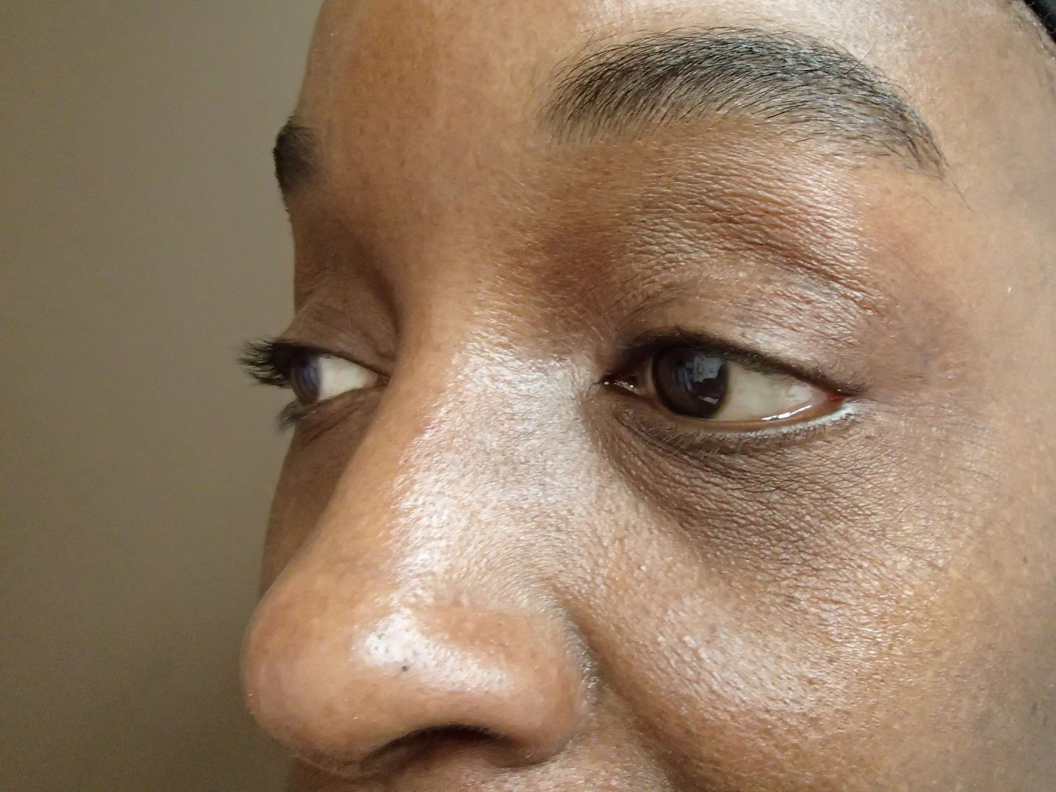 Blepharoplasty After
