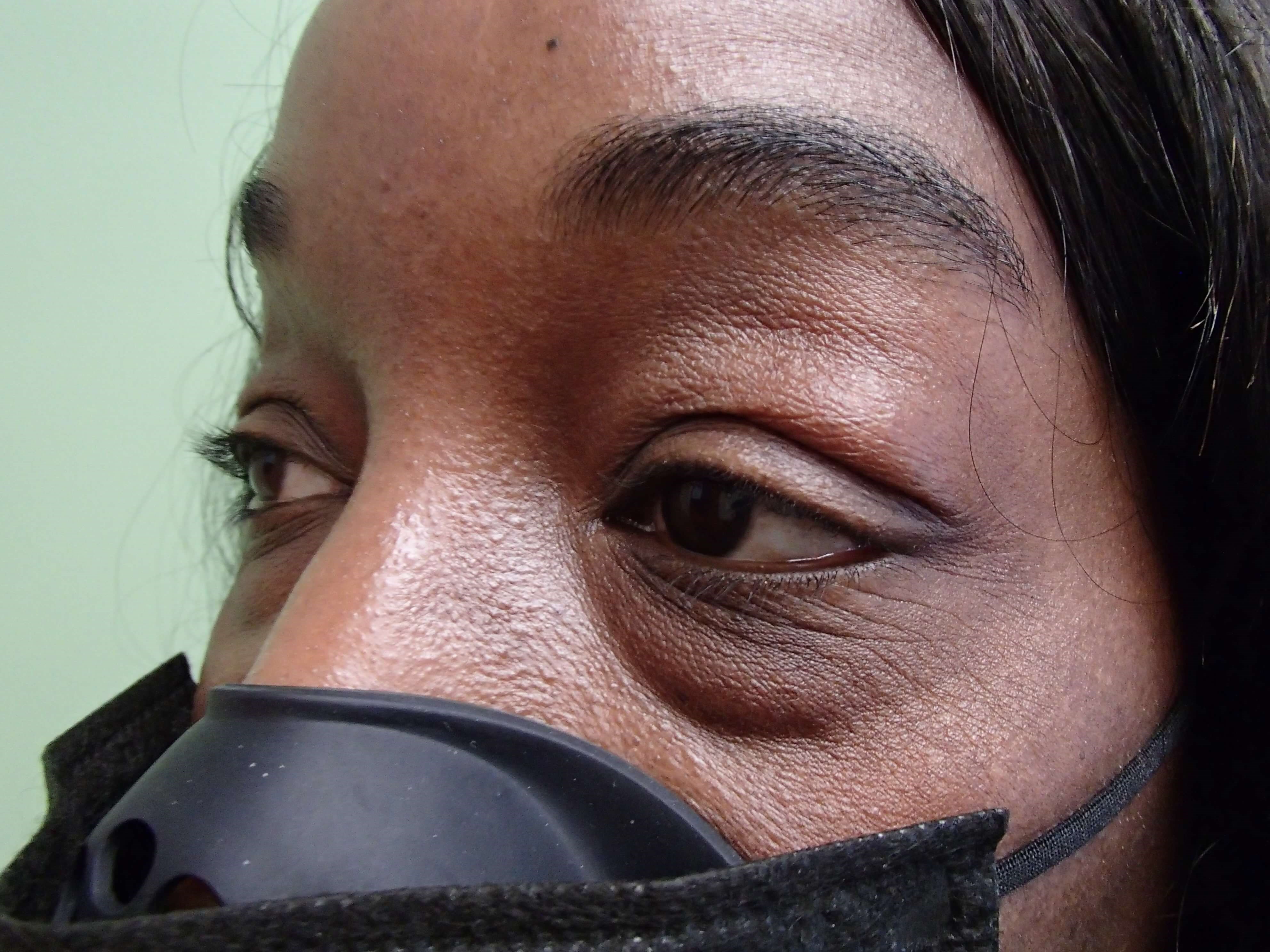 Blepharoplasty Before