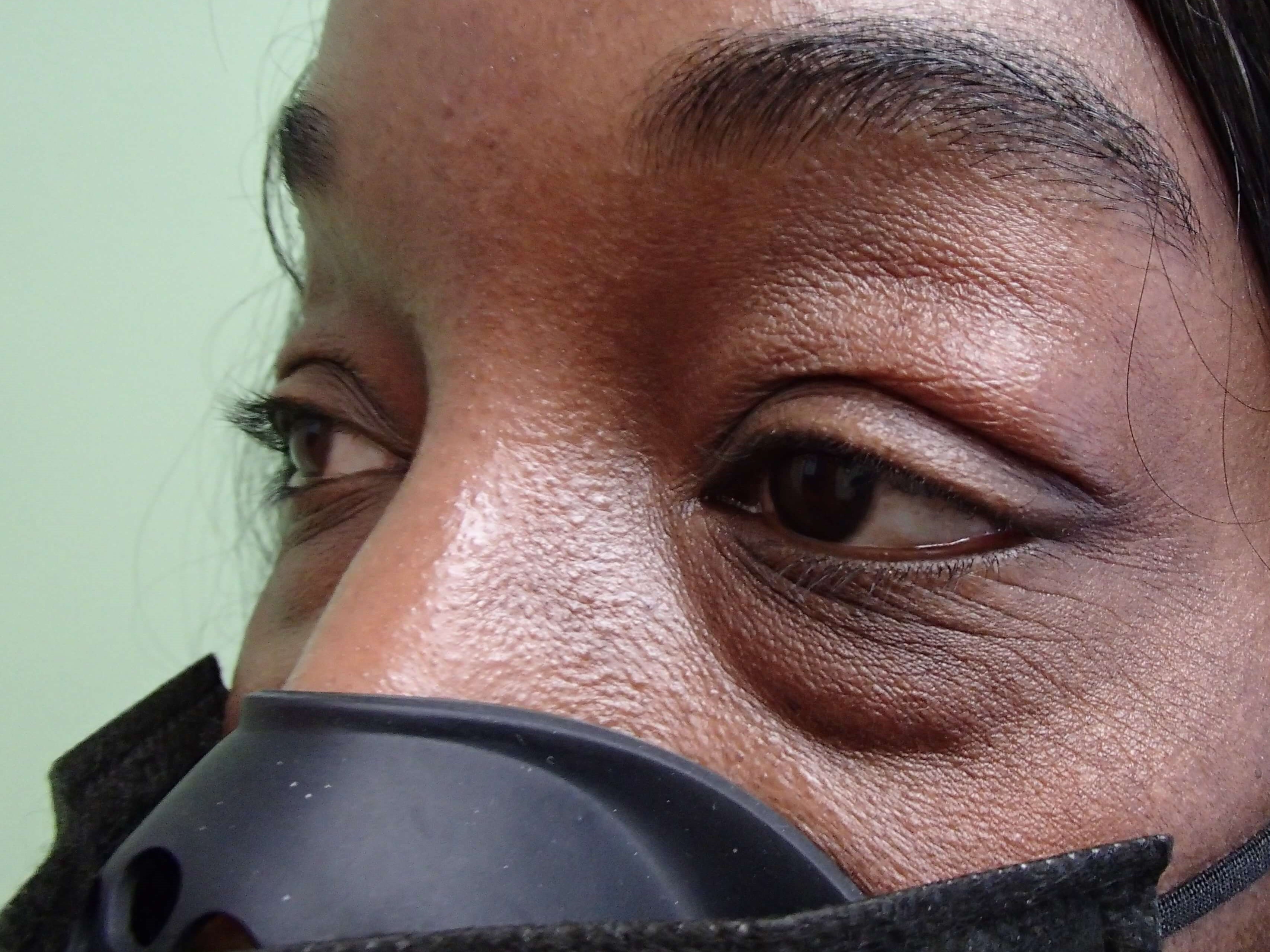 Blepharoplasty Before