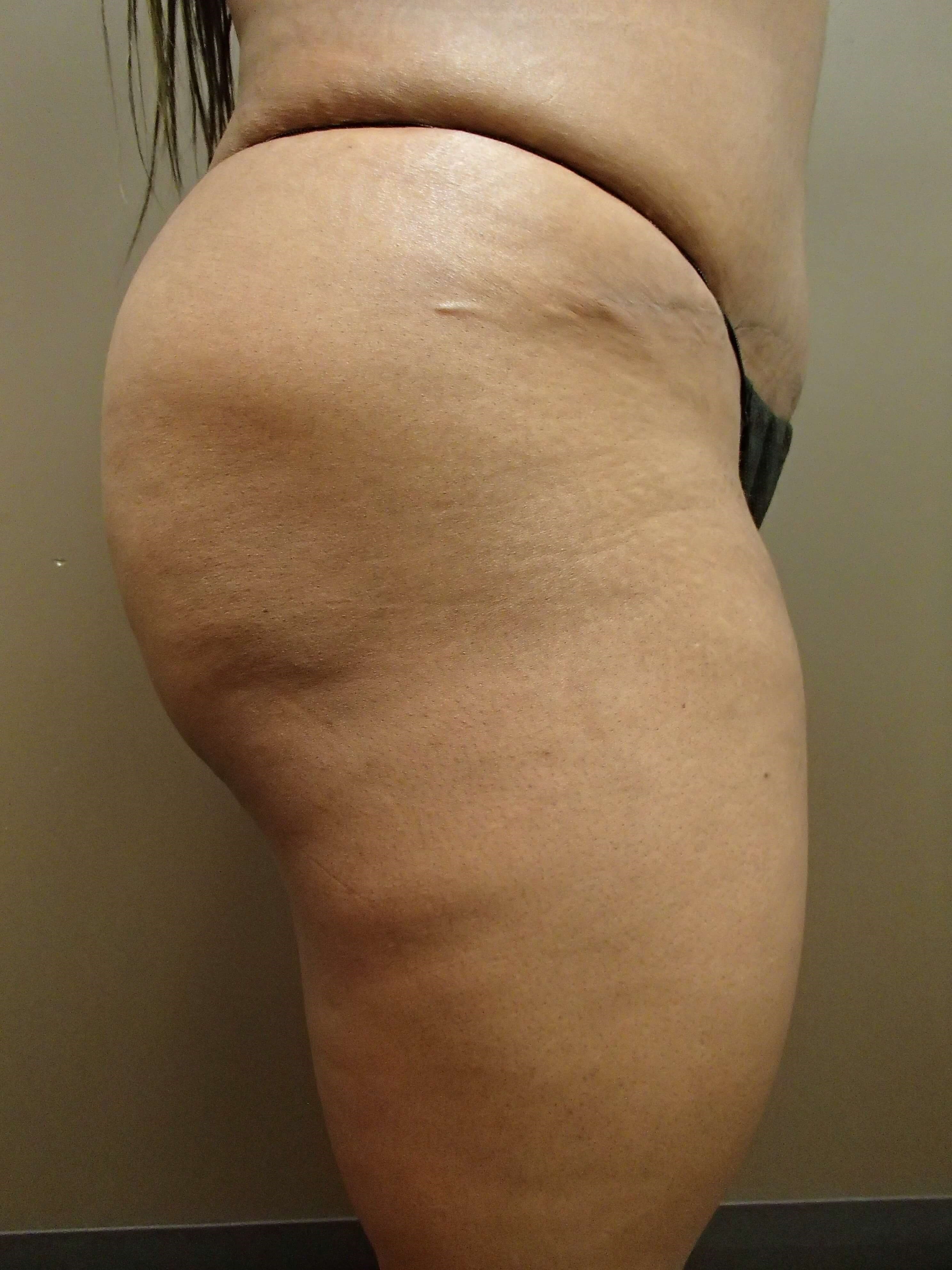 Auto Fat to Buttocks After