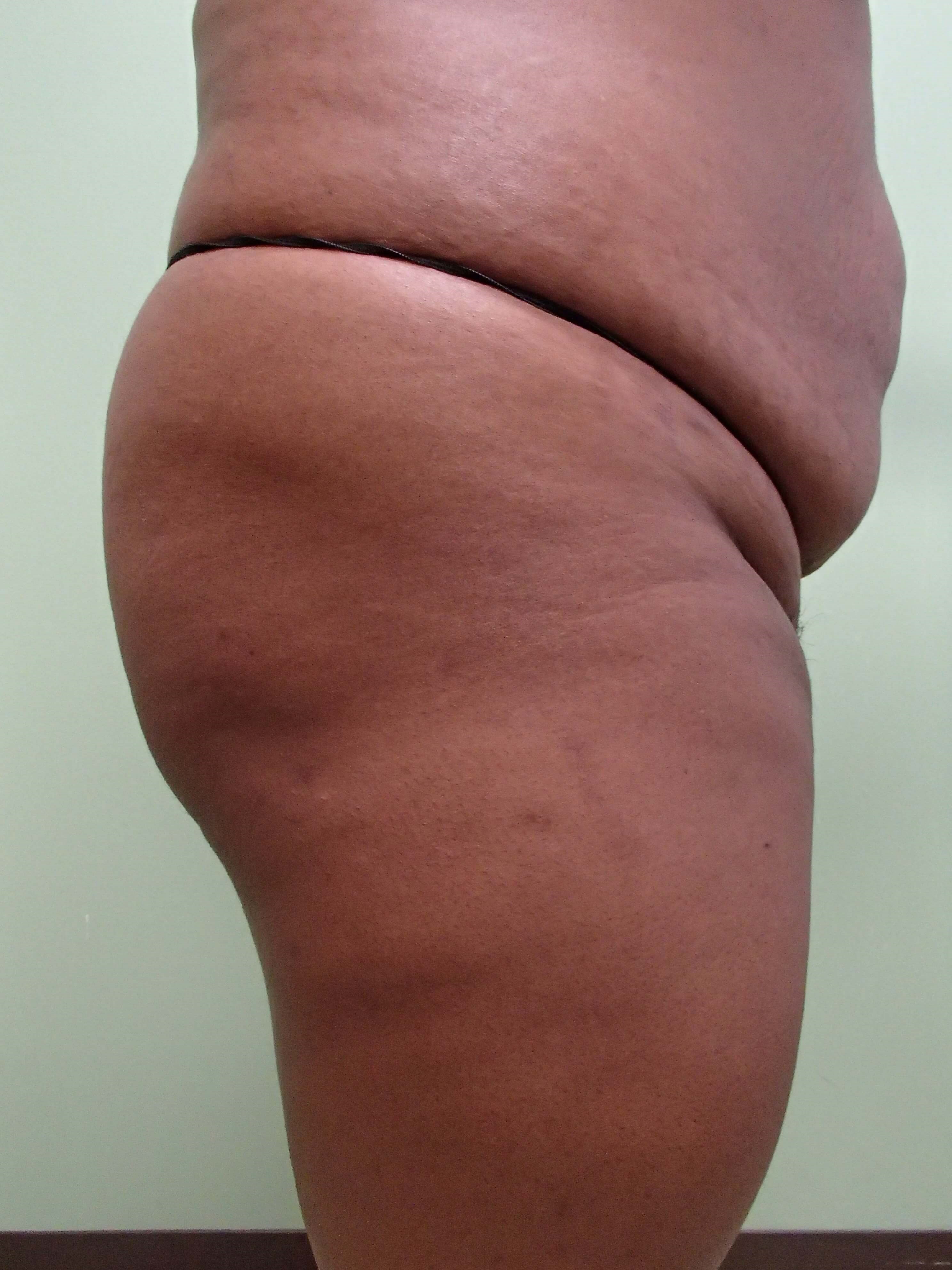Auto Fat to Buttocks Before