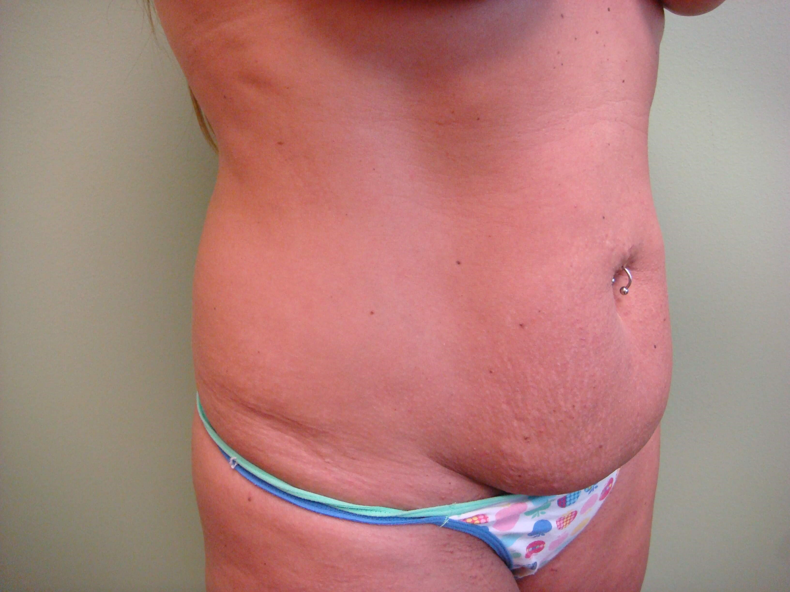 Abdominoplasty w/ Liposuction Before
