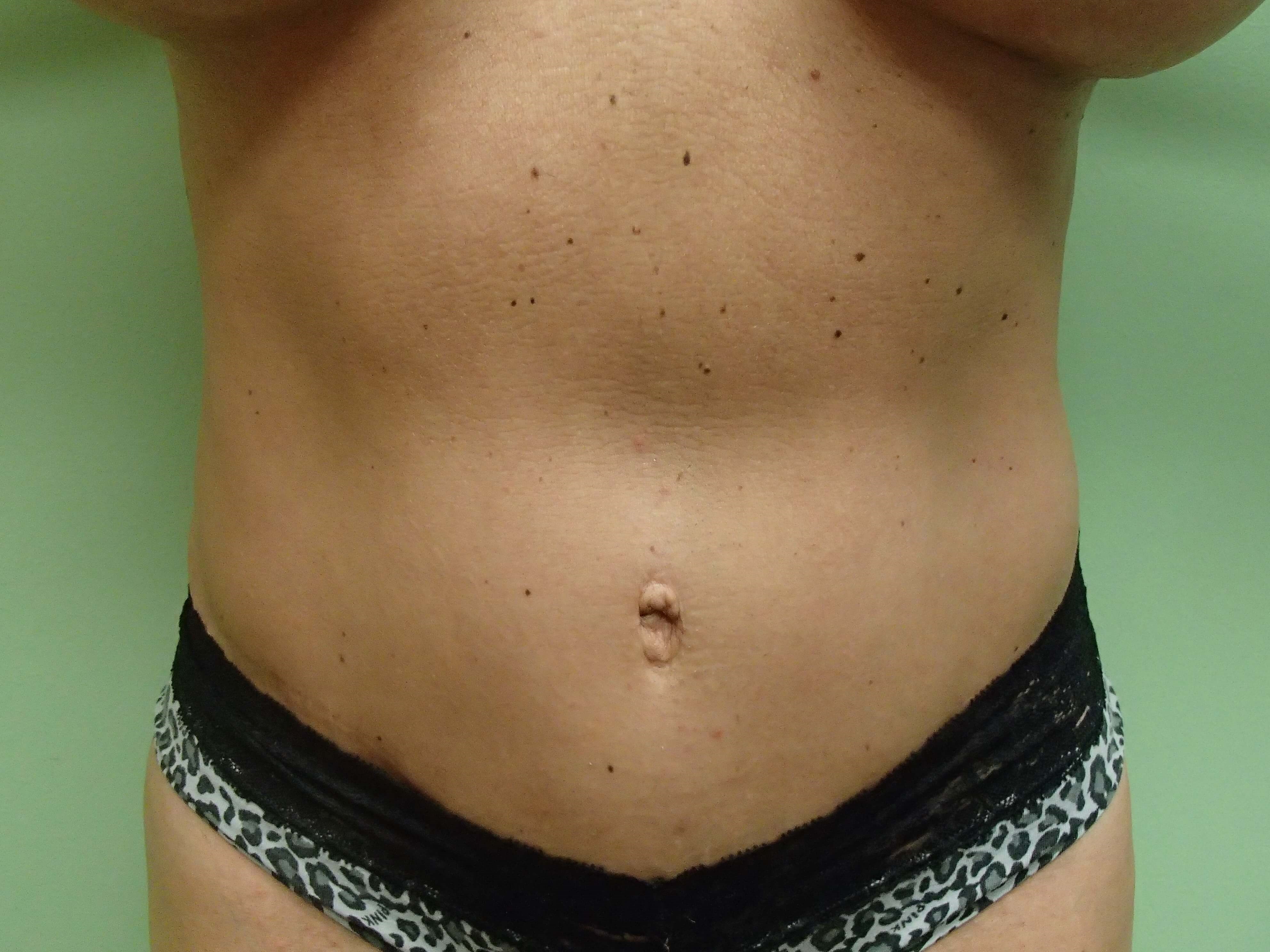 Abdominoplasty w/ Liposuction After