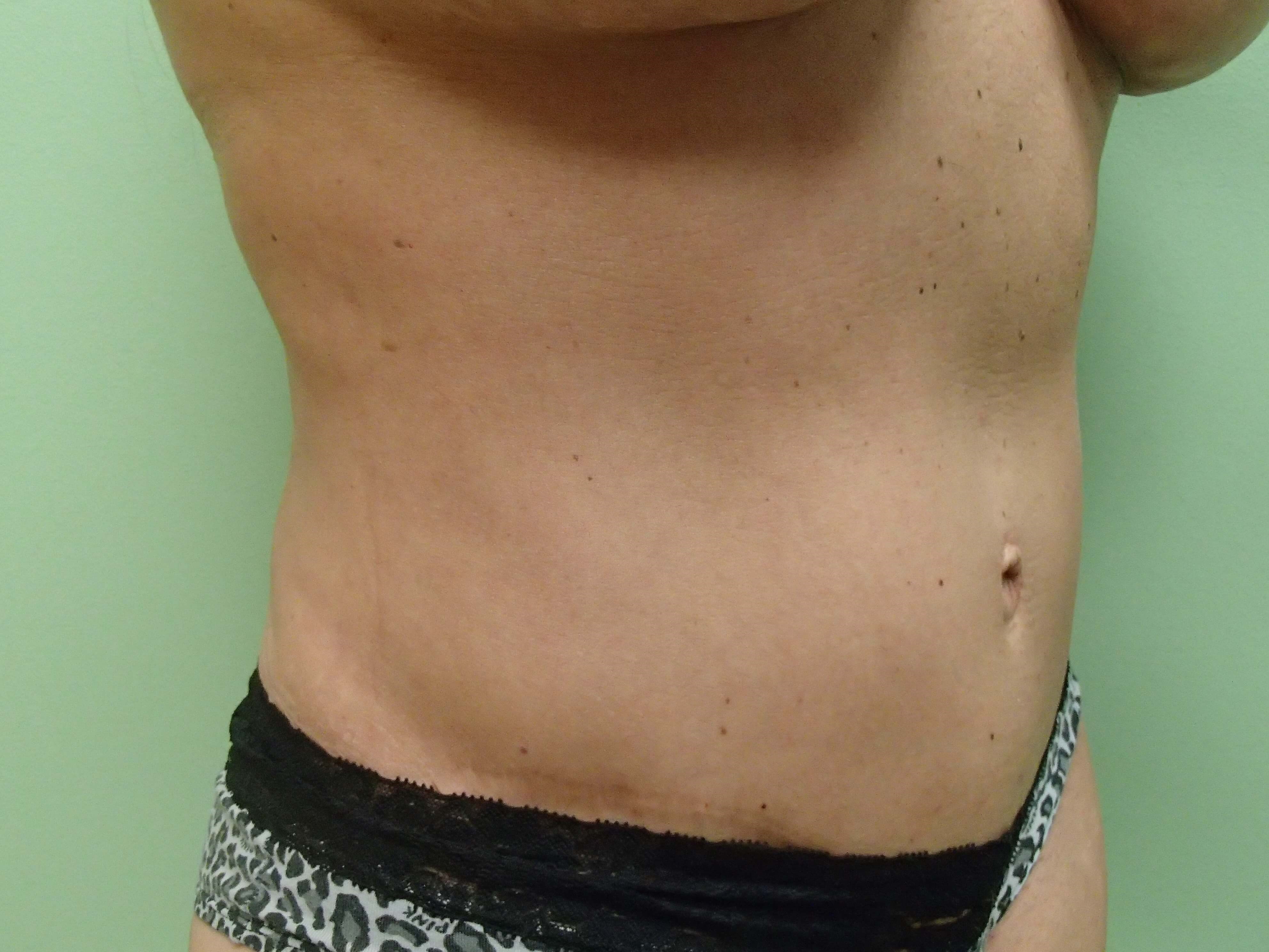 Abdominoplasty w/ Liposuction After