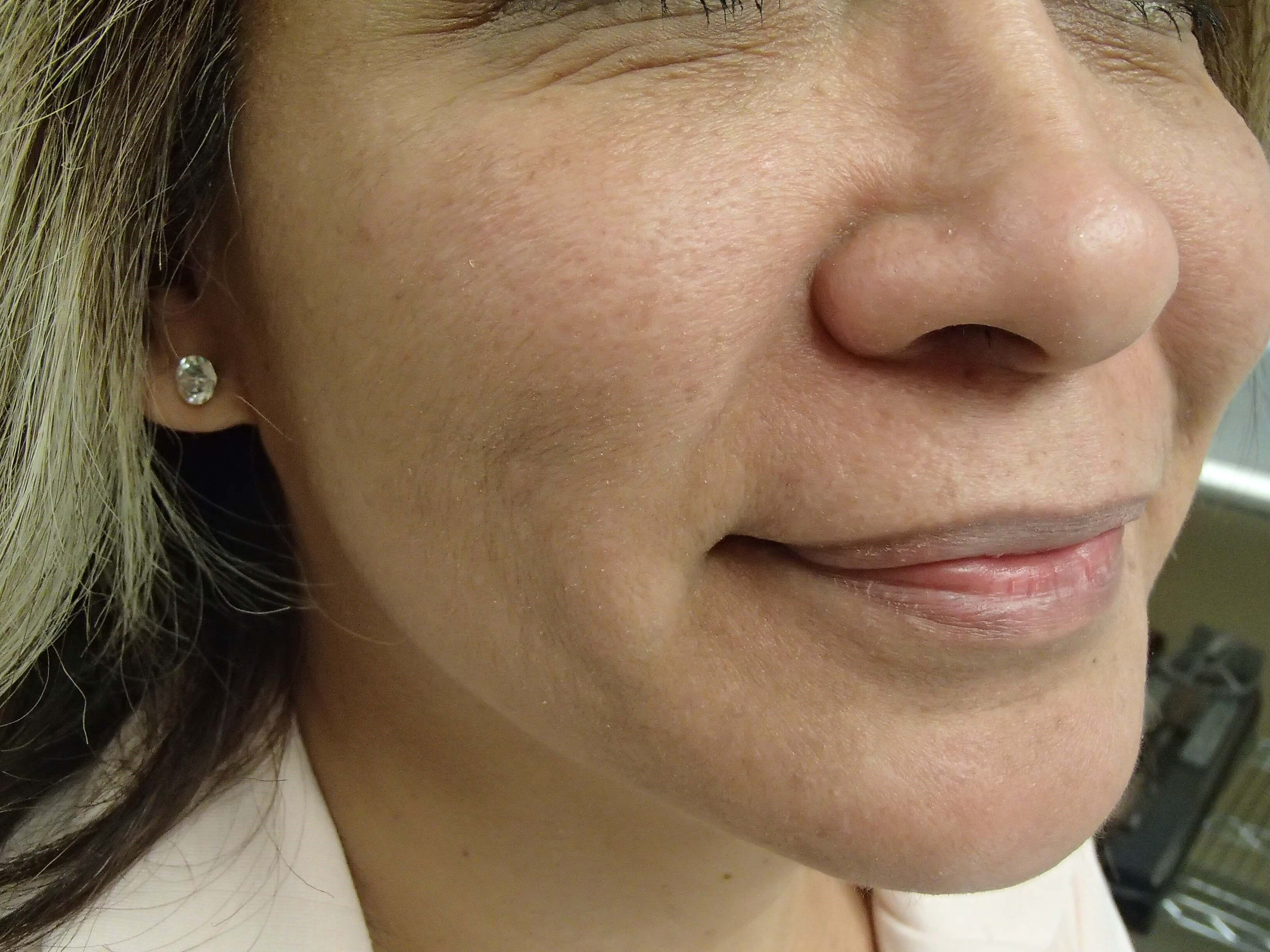 Timeless Dimple Before