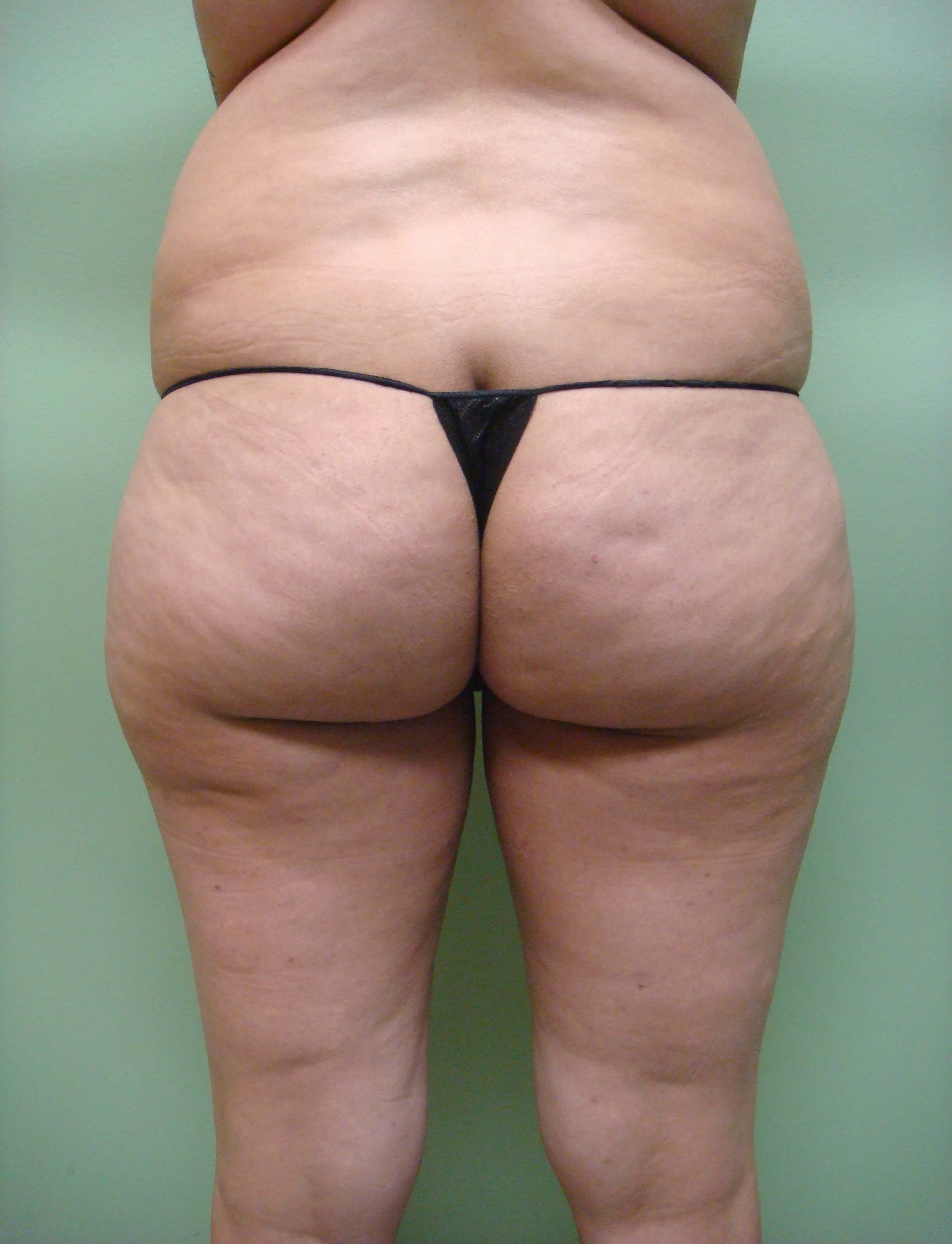 Liposuction Before