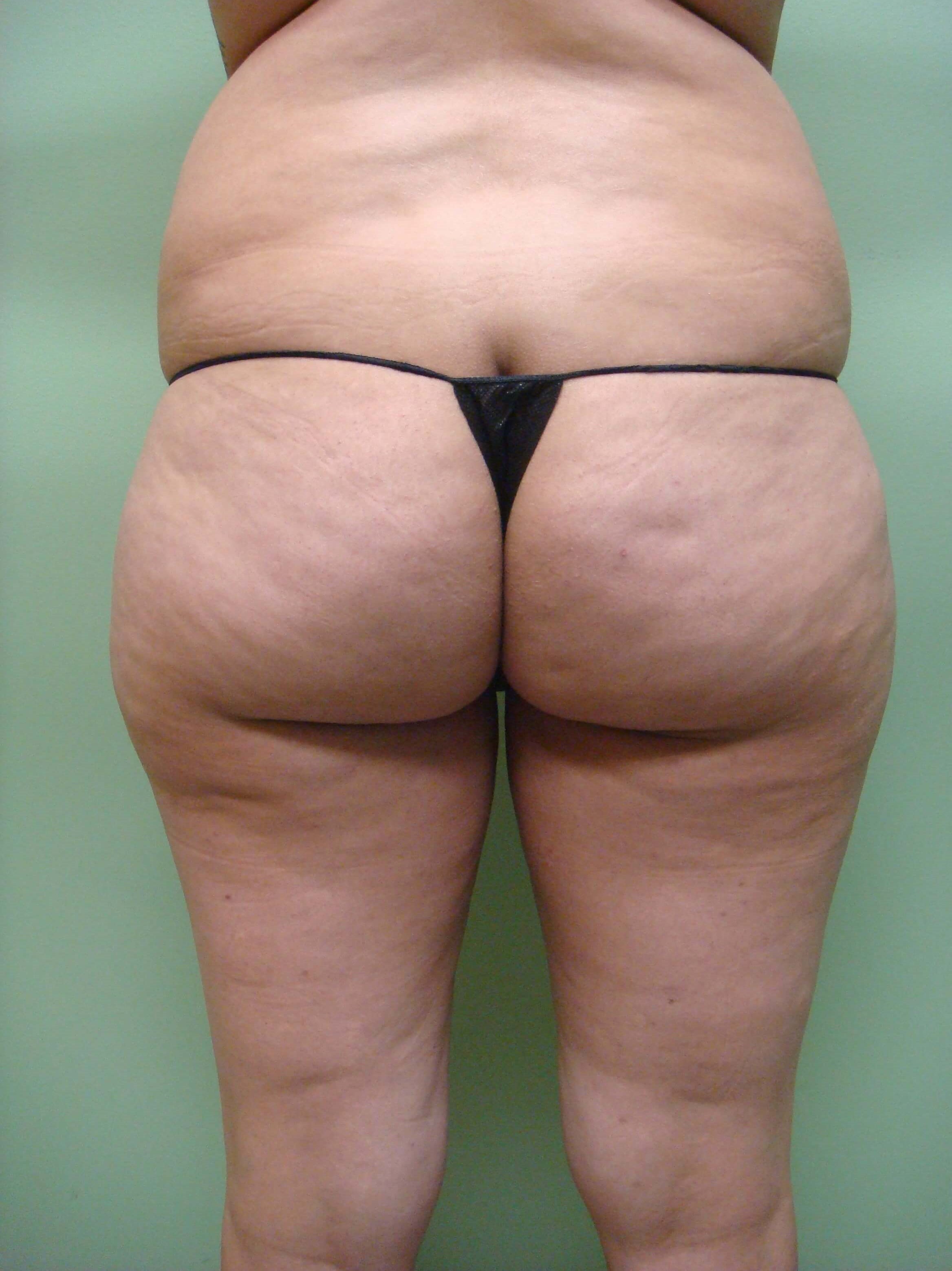 Liposuction Before