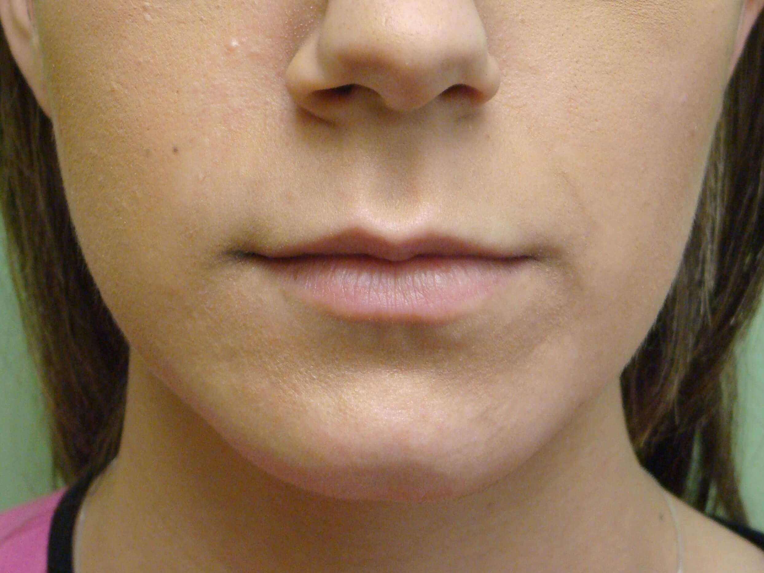 Juvederm Before