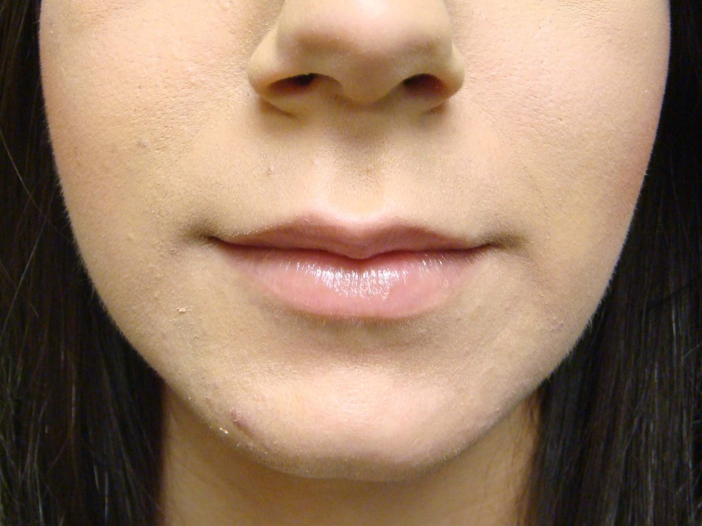 Juvederm After