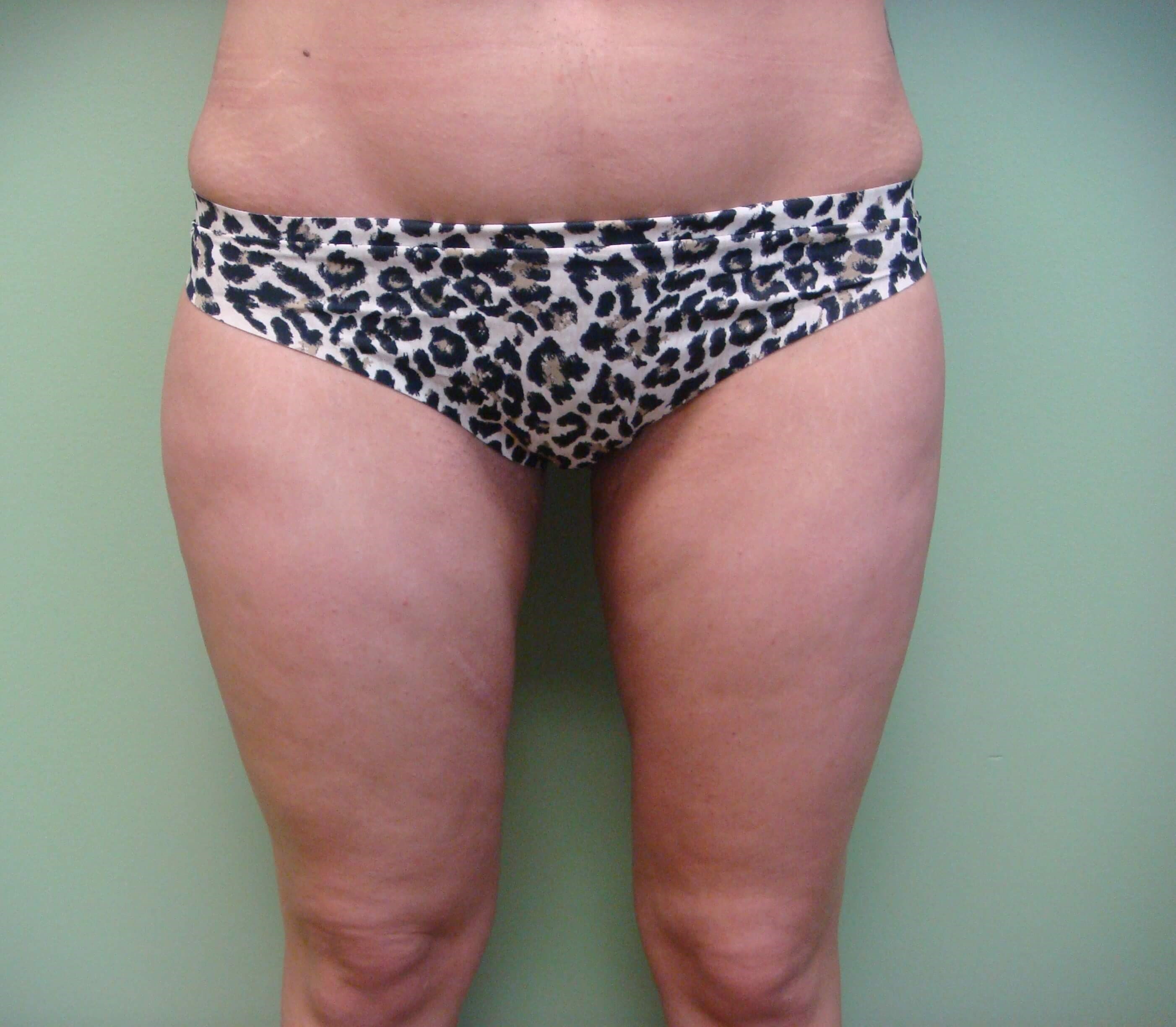 Liposuction After