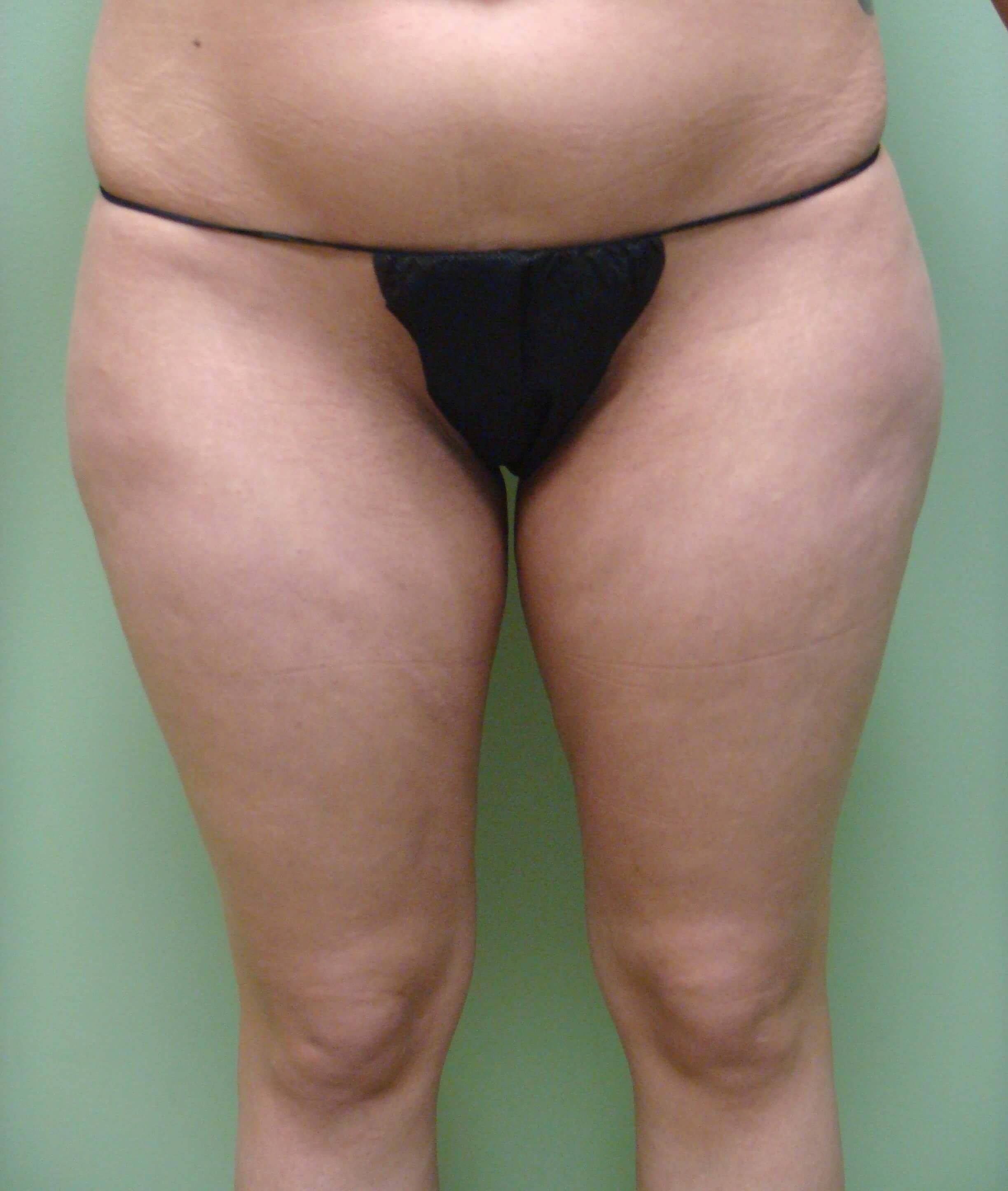 Liposuction Before