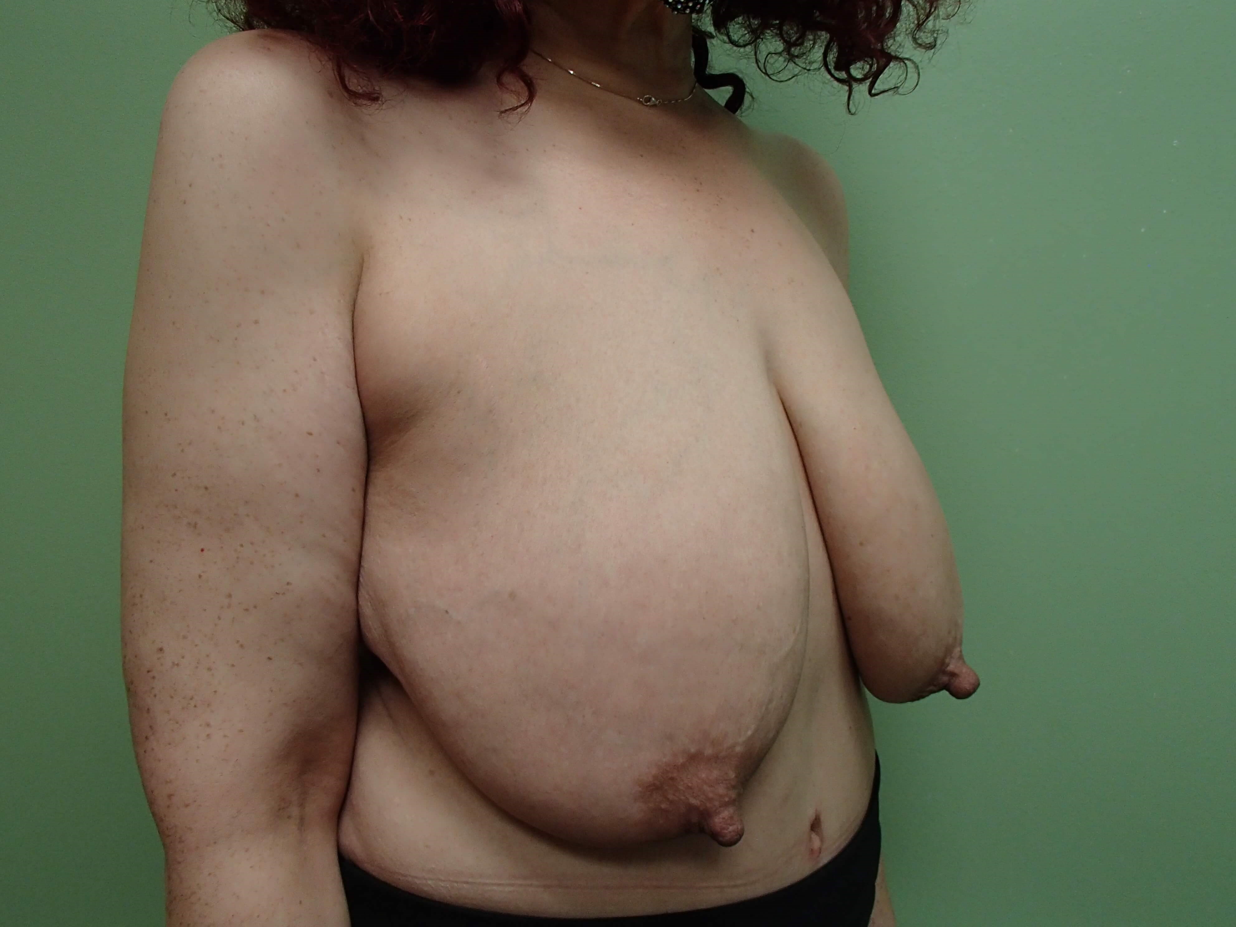 Mastopexy Before