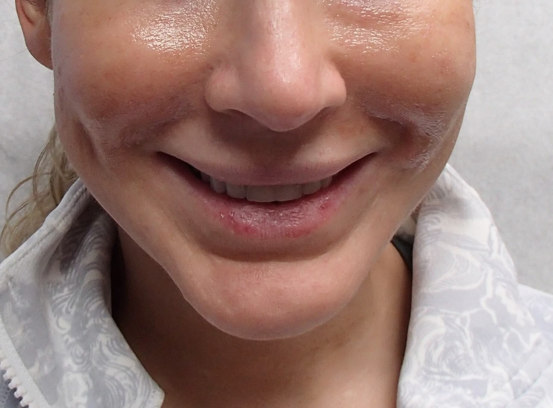 Botox to Masseters Before