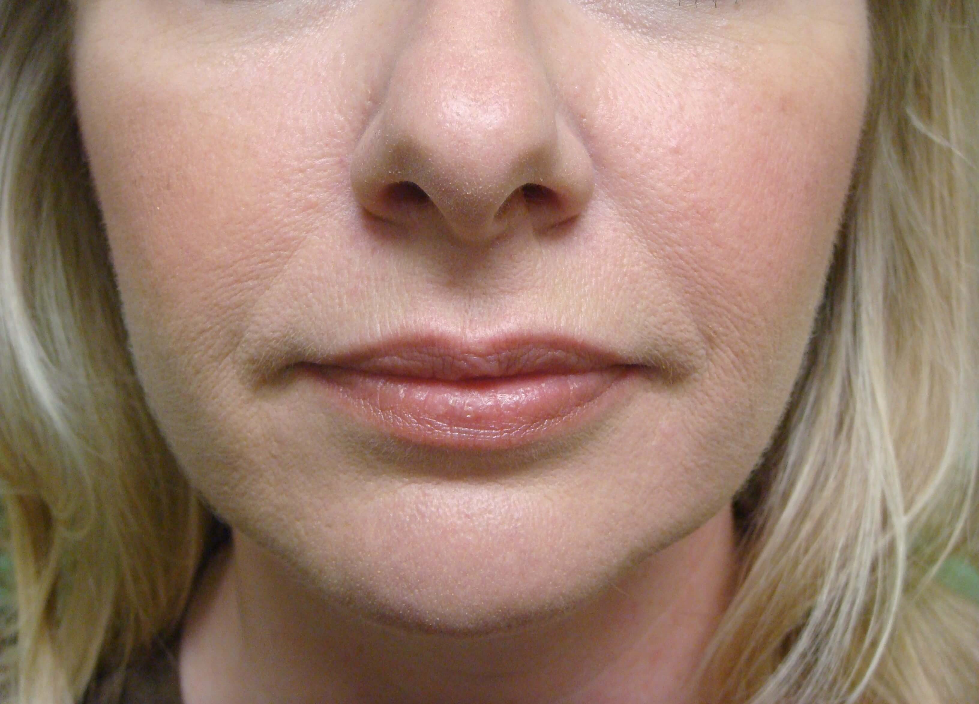 Botox to Masseters Before