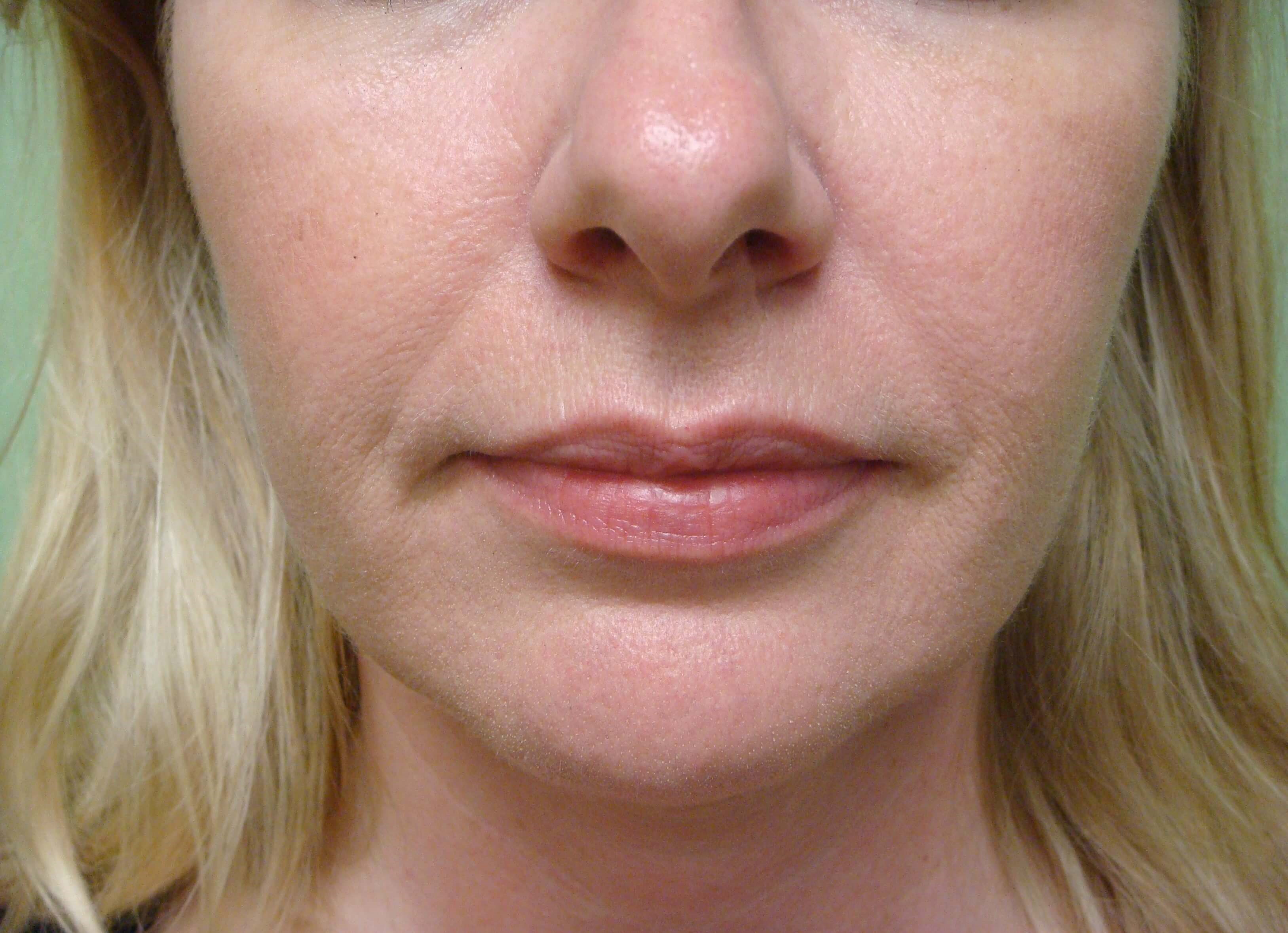 Botox to Masseters After