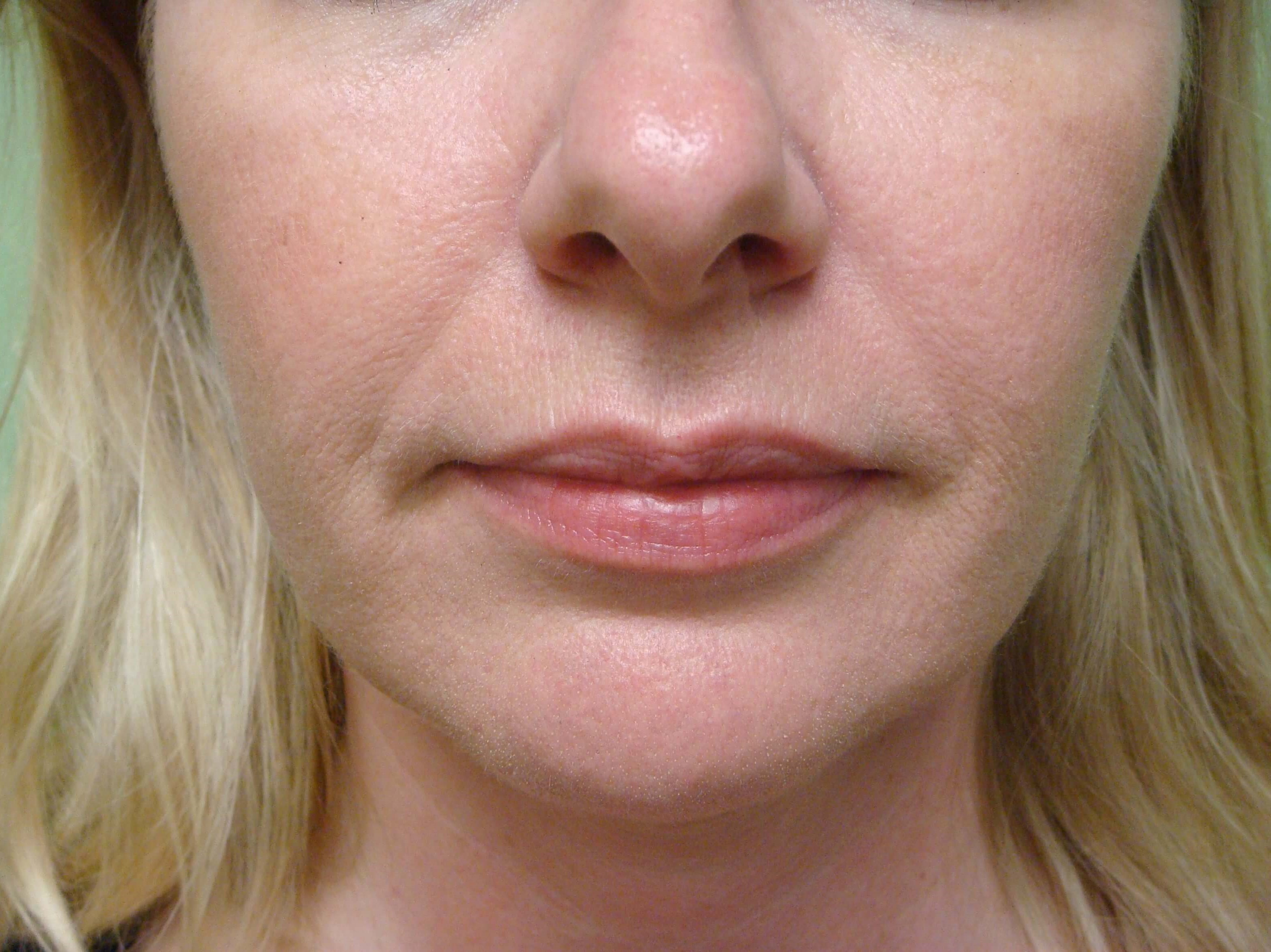 Botox to Masseters After