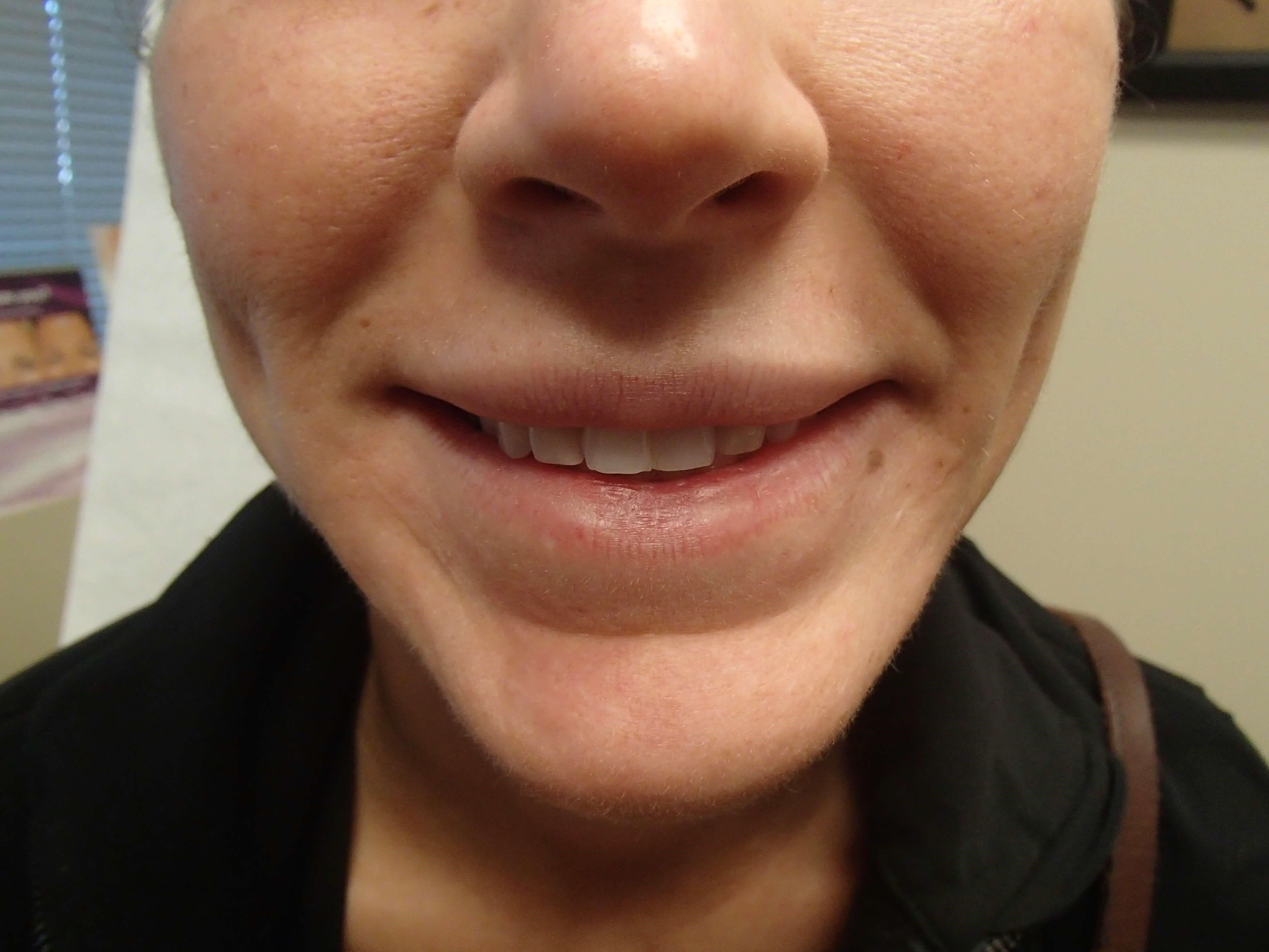 Botox to Masseters After
