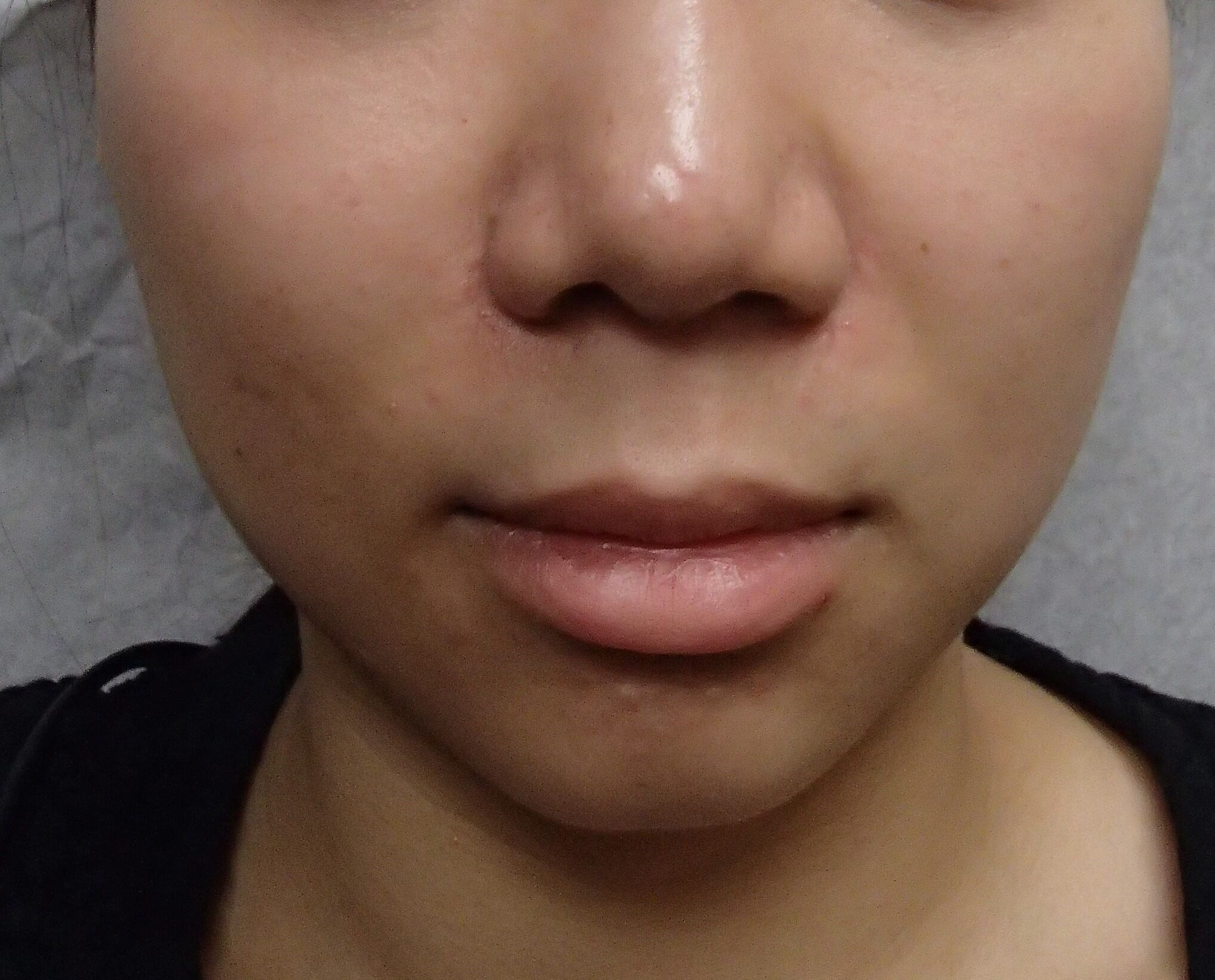Botox to Masseters After