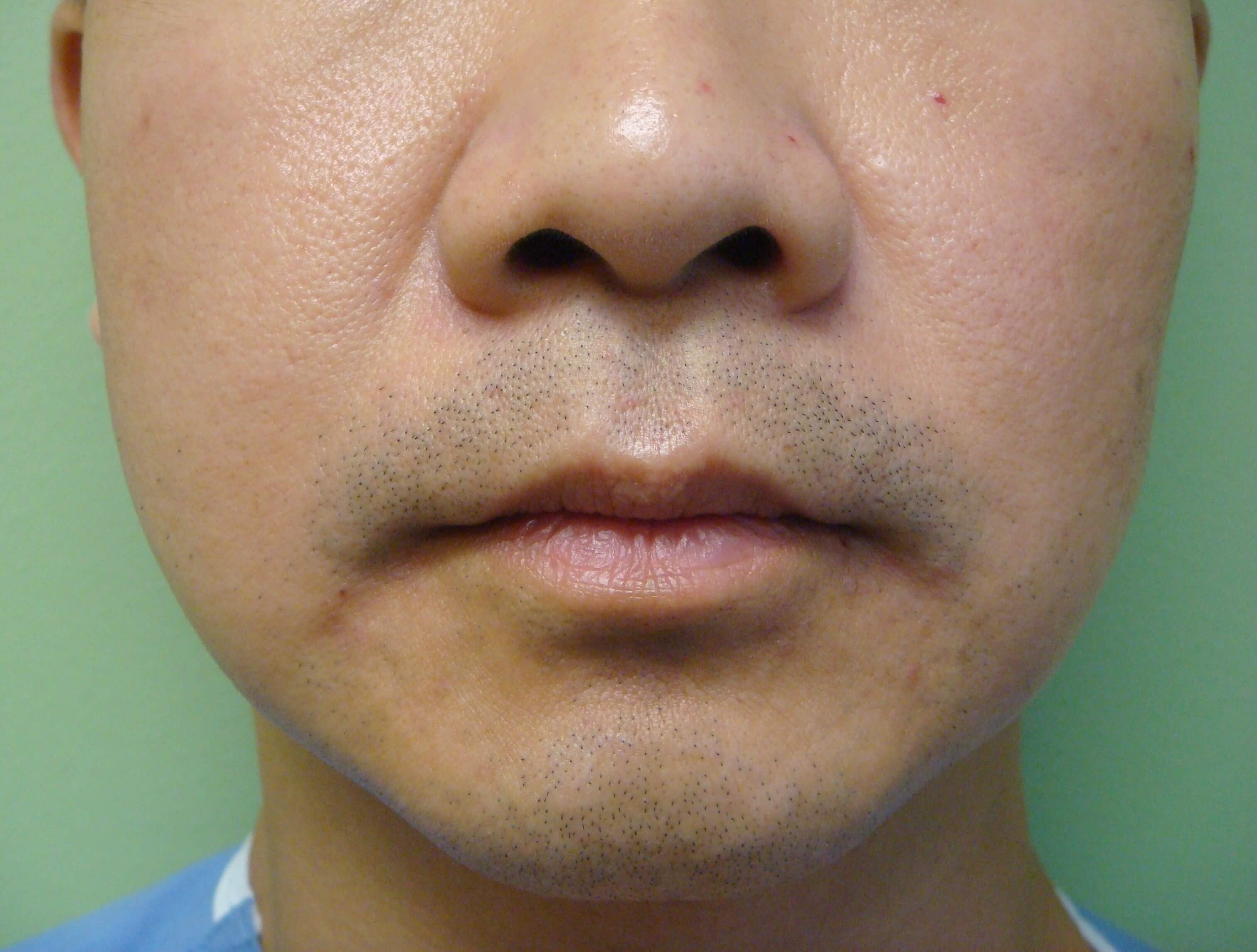 Botox to Masseters After