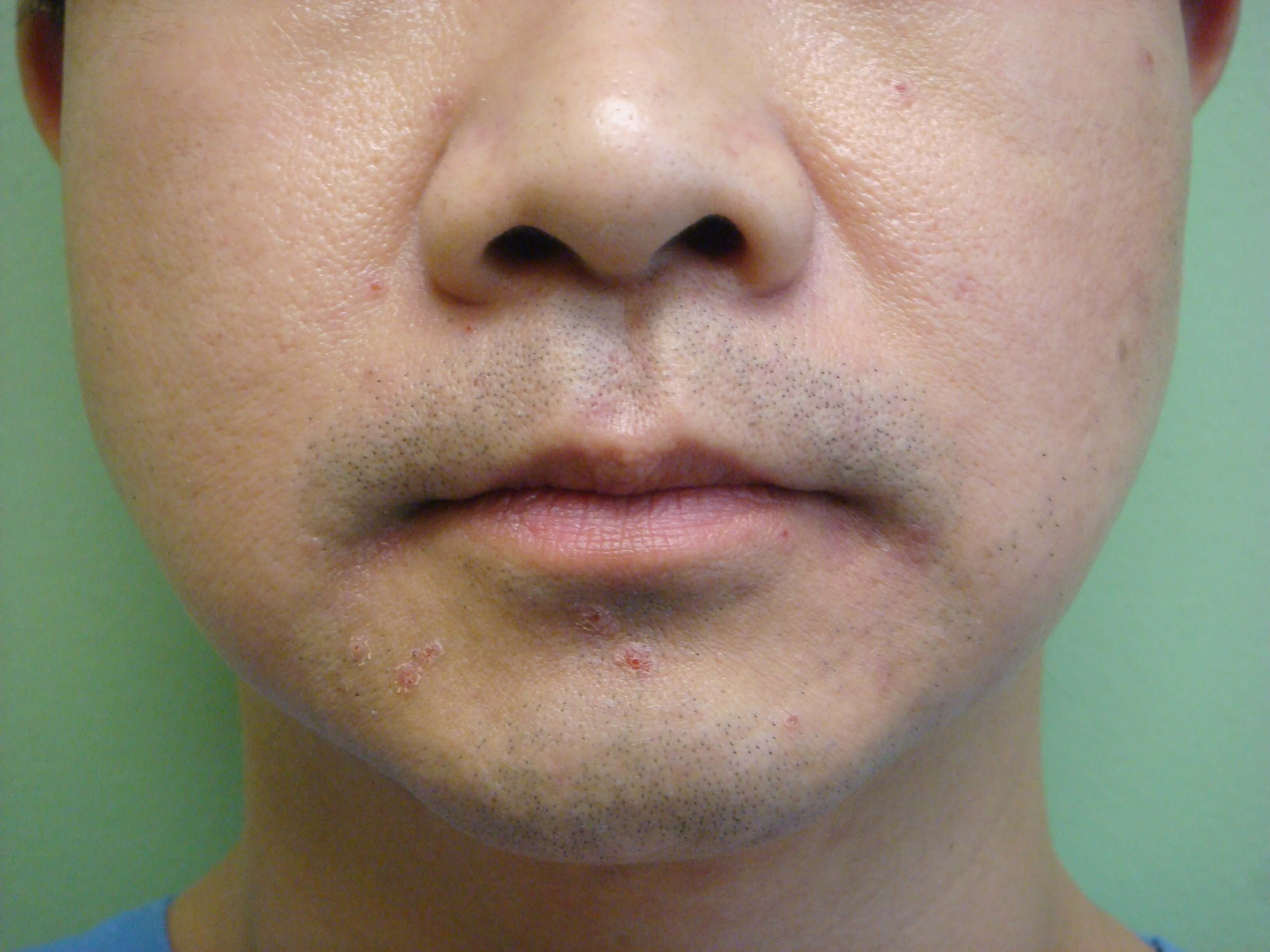 Botox to Masseters Before