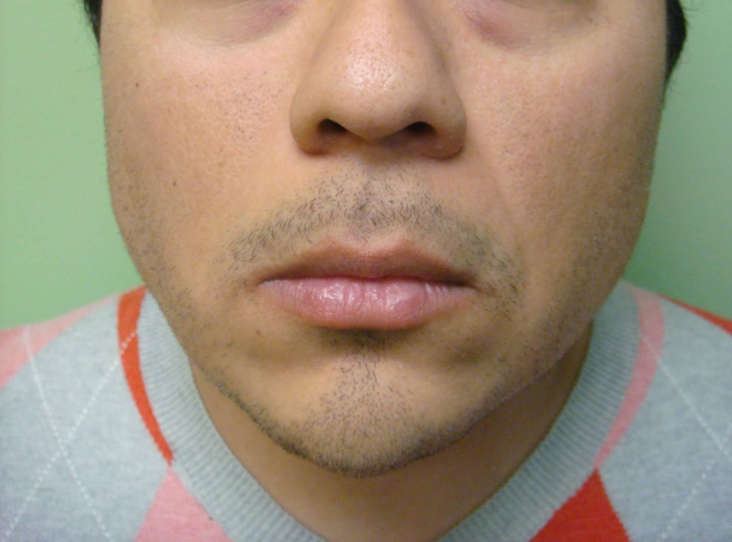 Botox to Masseters Before