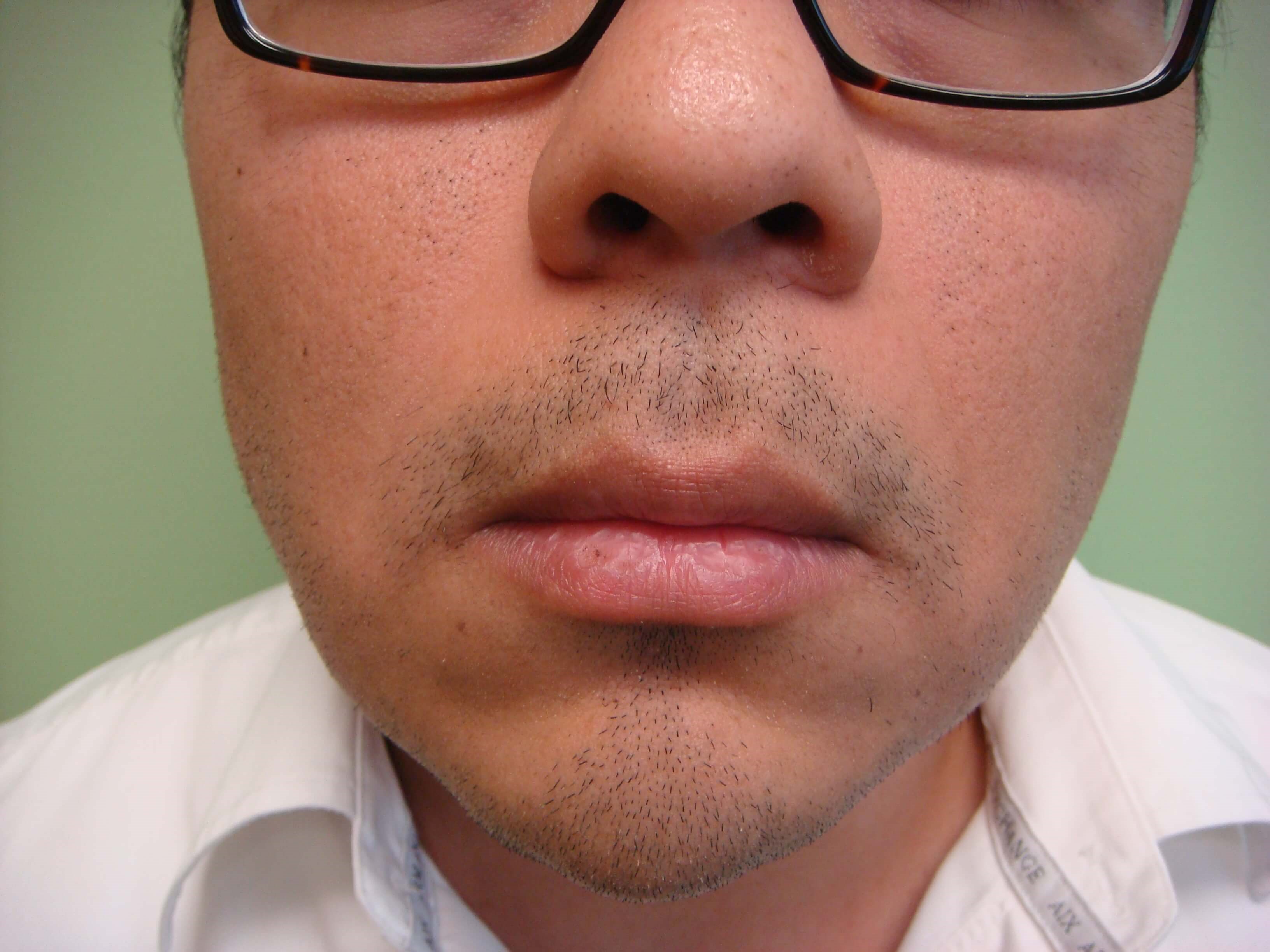 Botox to Masseters After