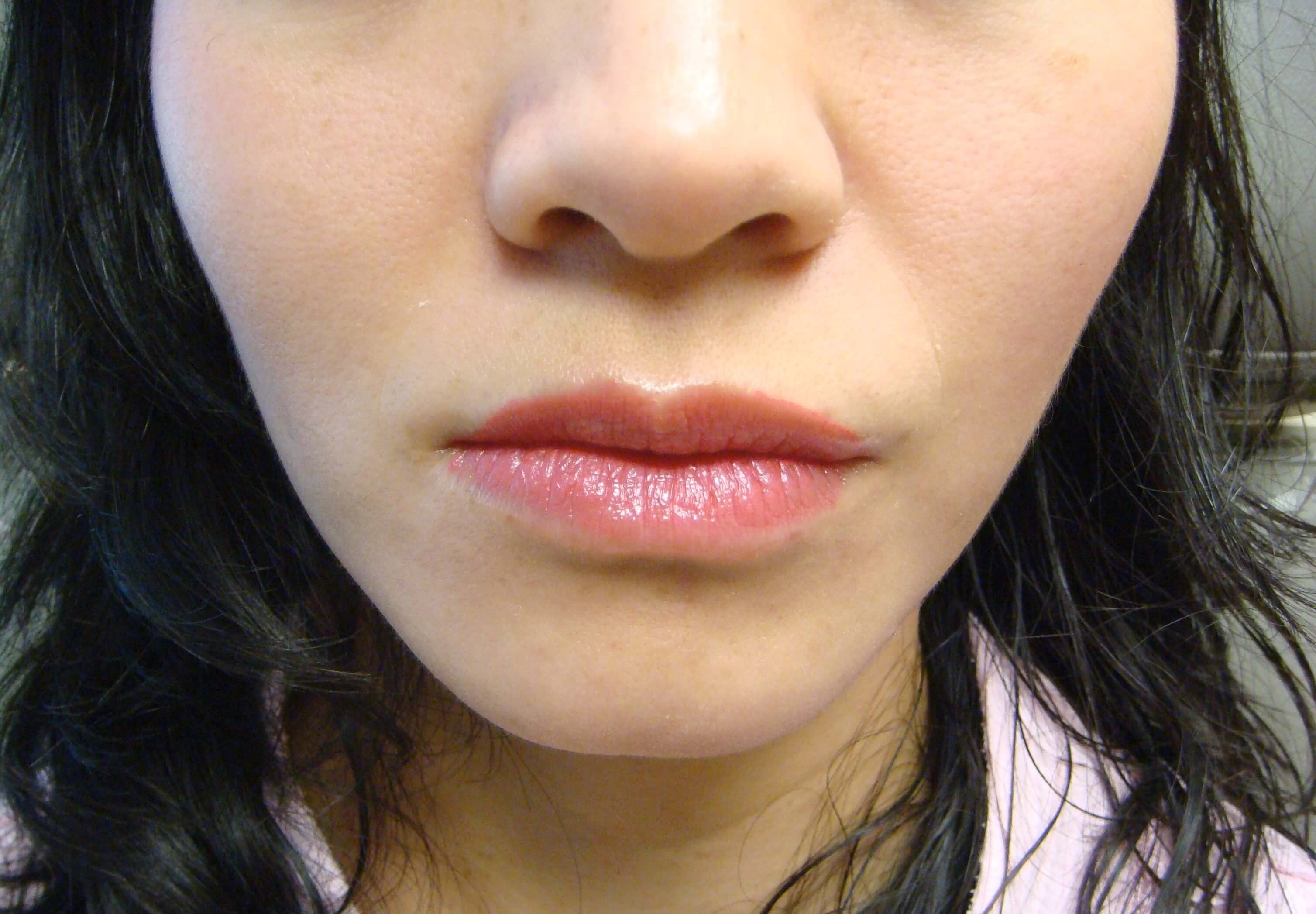 Botox to Masseters After