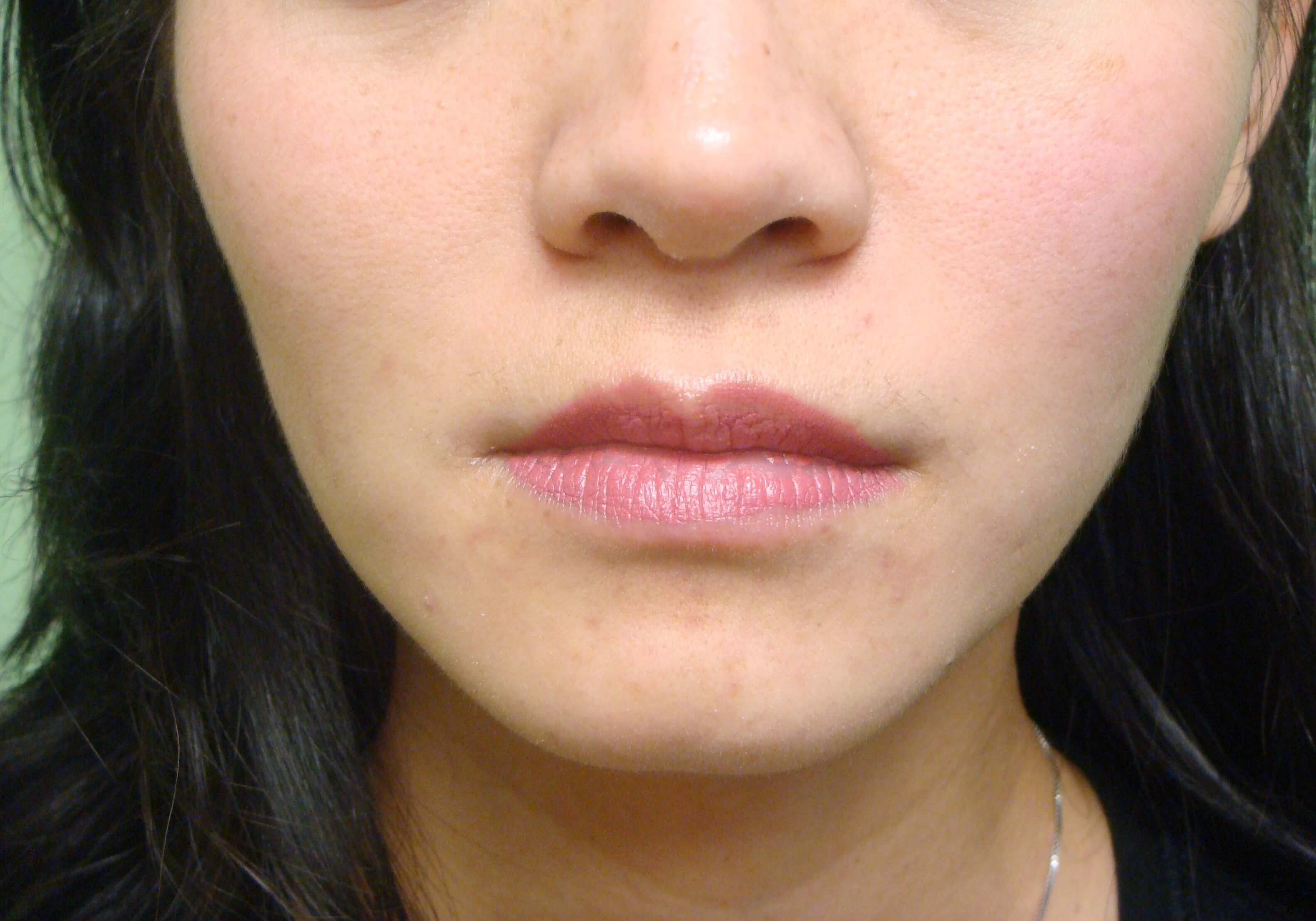 Botox to Masseters Before