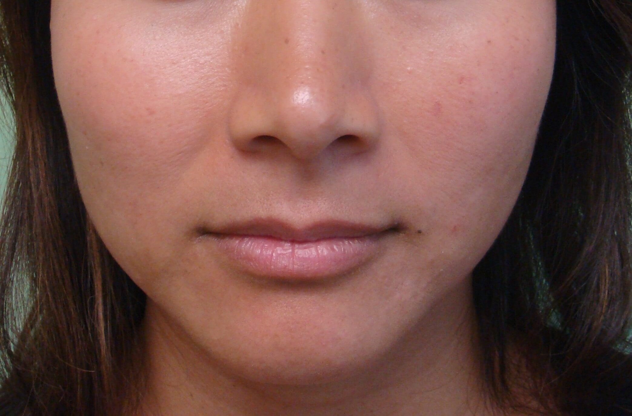 Botox to Masseters Before