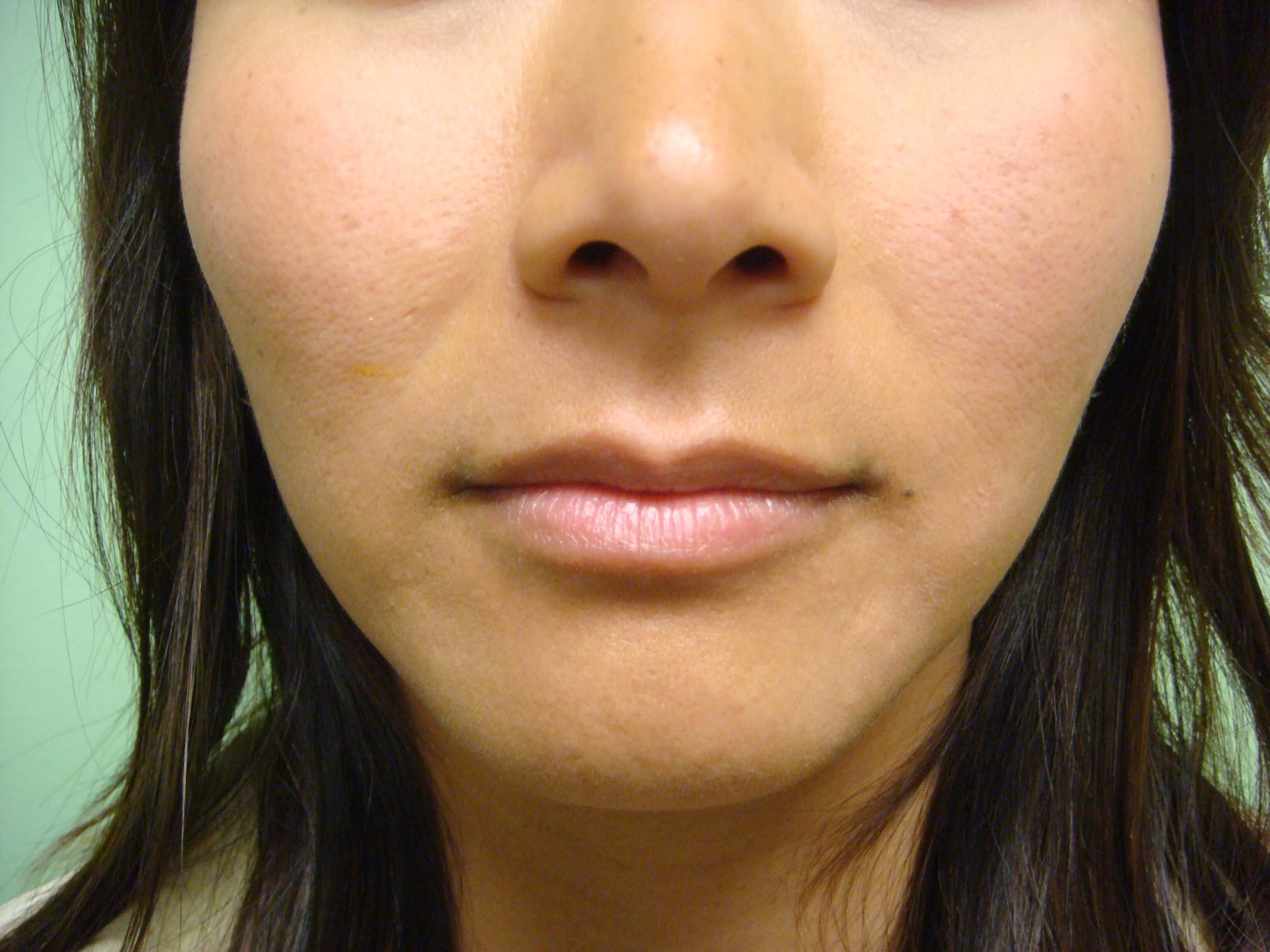 Botox to Masseters After
