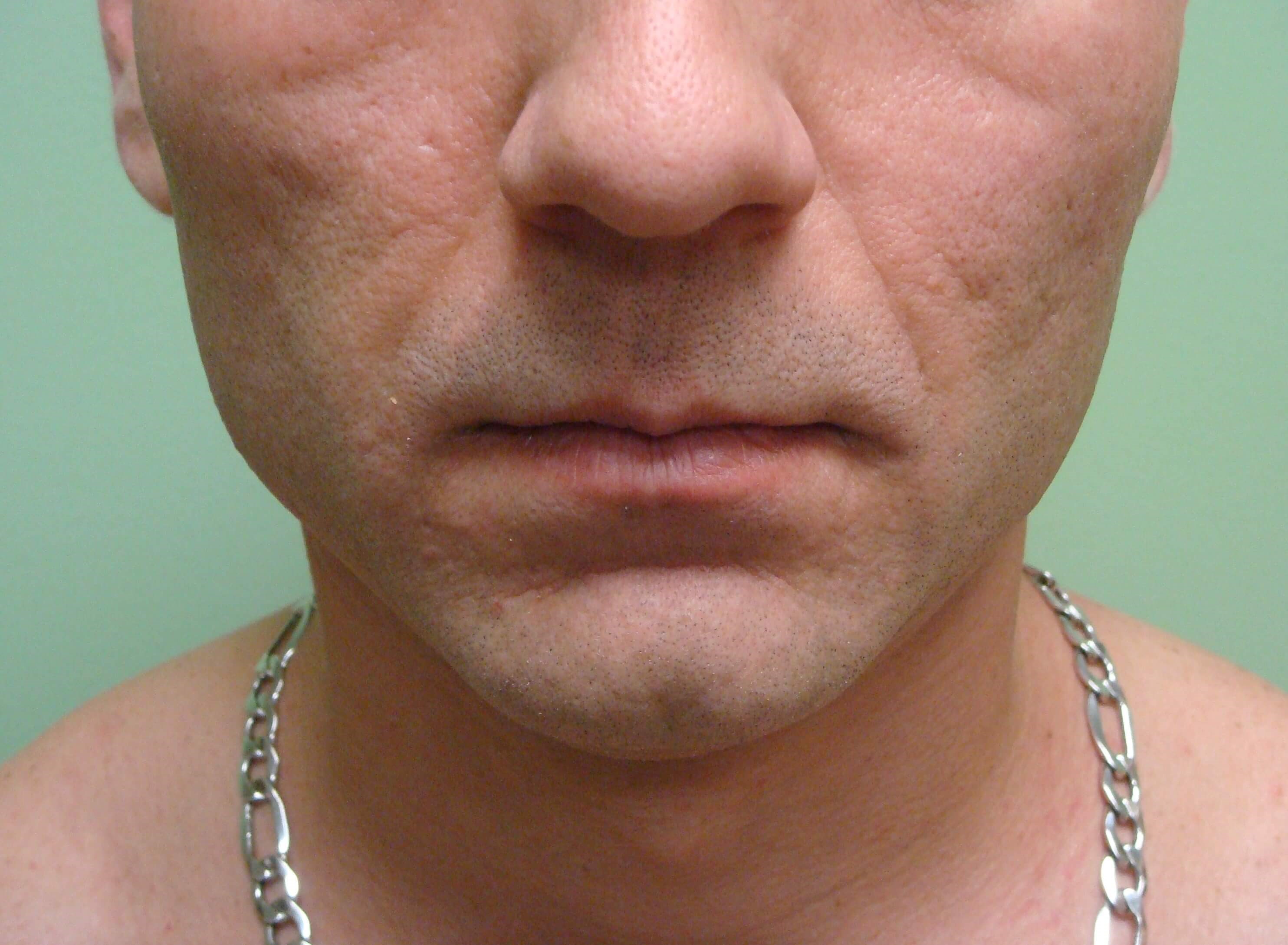 Botox to Masseters After