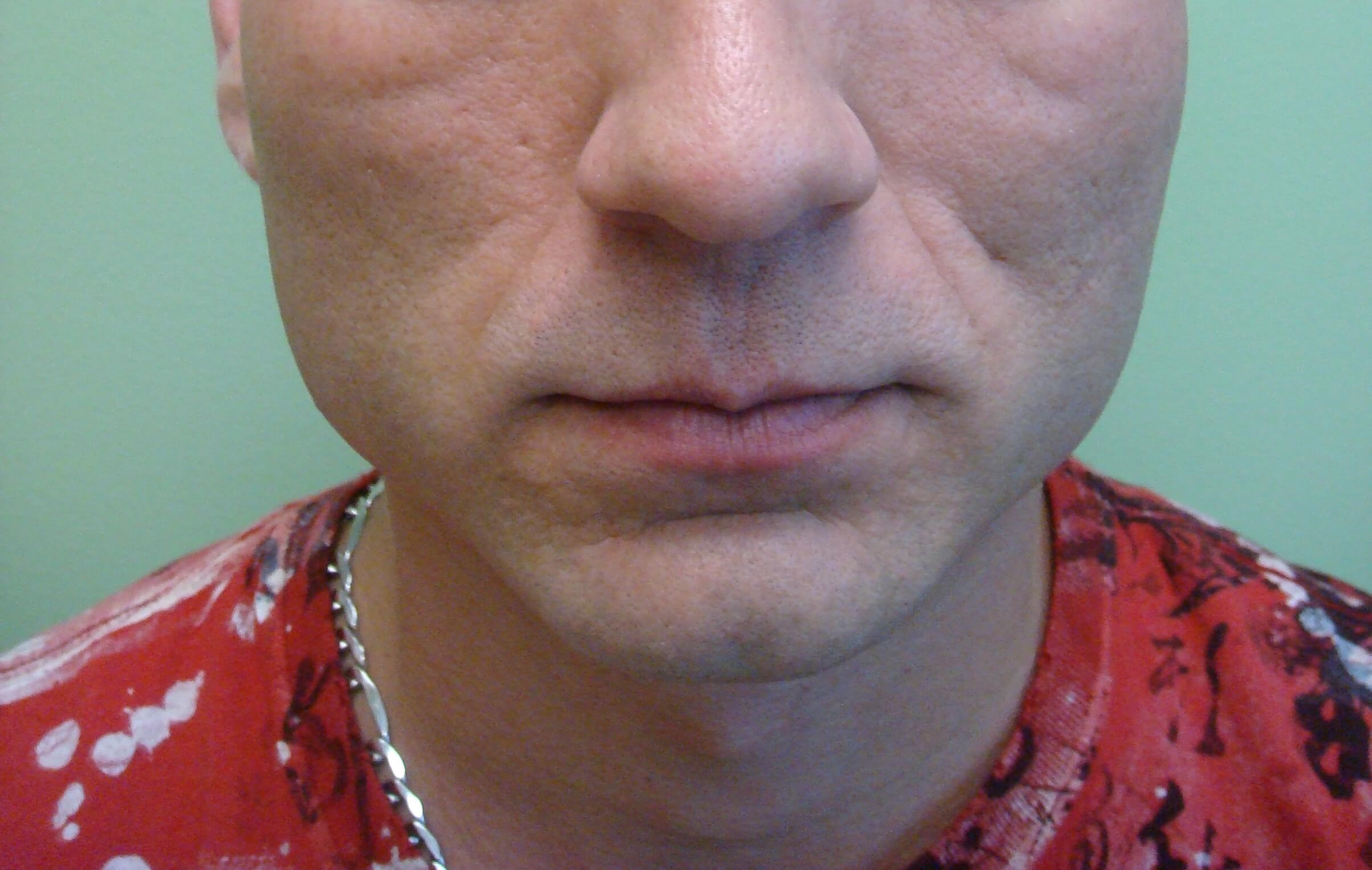 Botox to Masseters Before