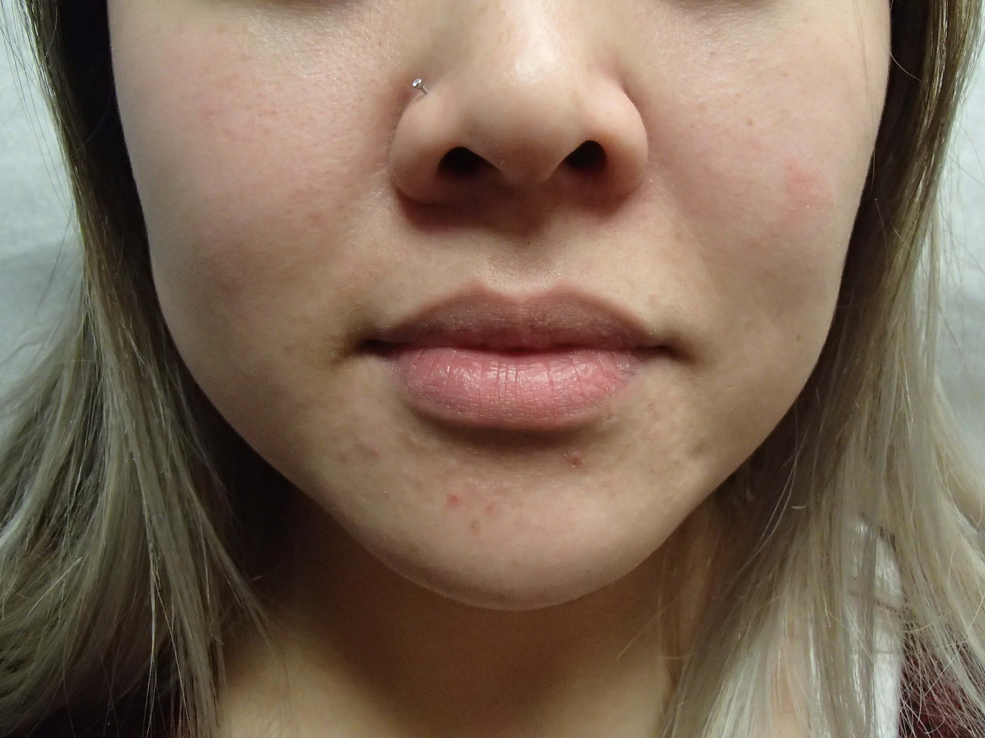 Botox w/ Buccal Fat Removal Before