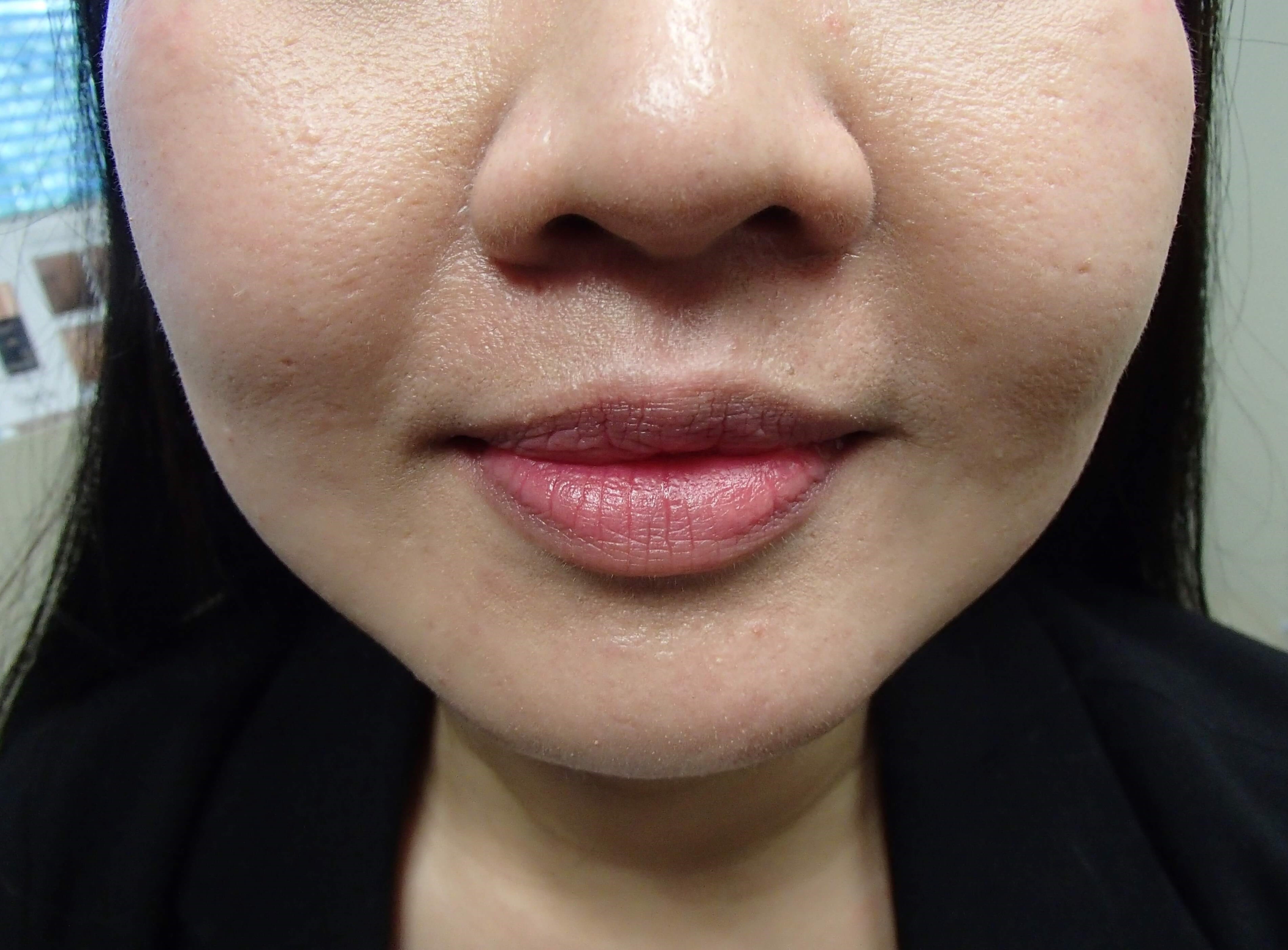 Botox w/ Buccal Fat Removal After