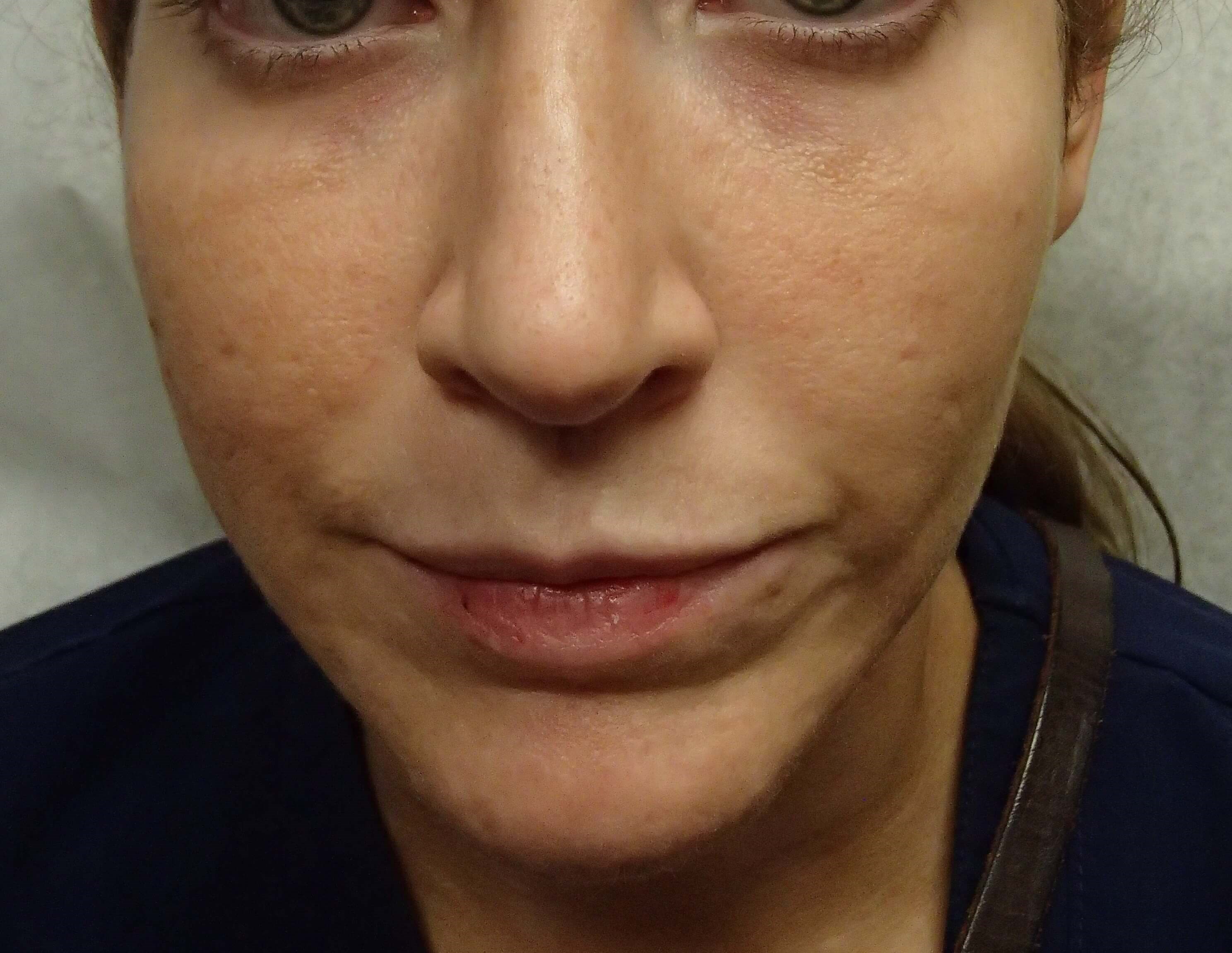 Botox to Masseters After