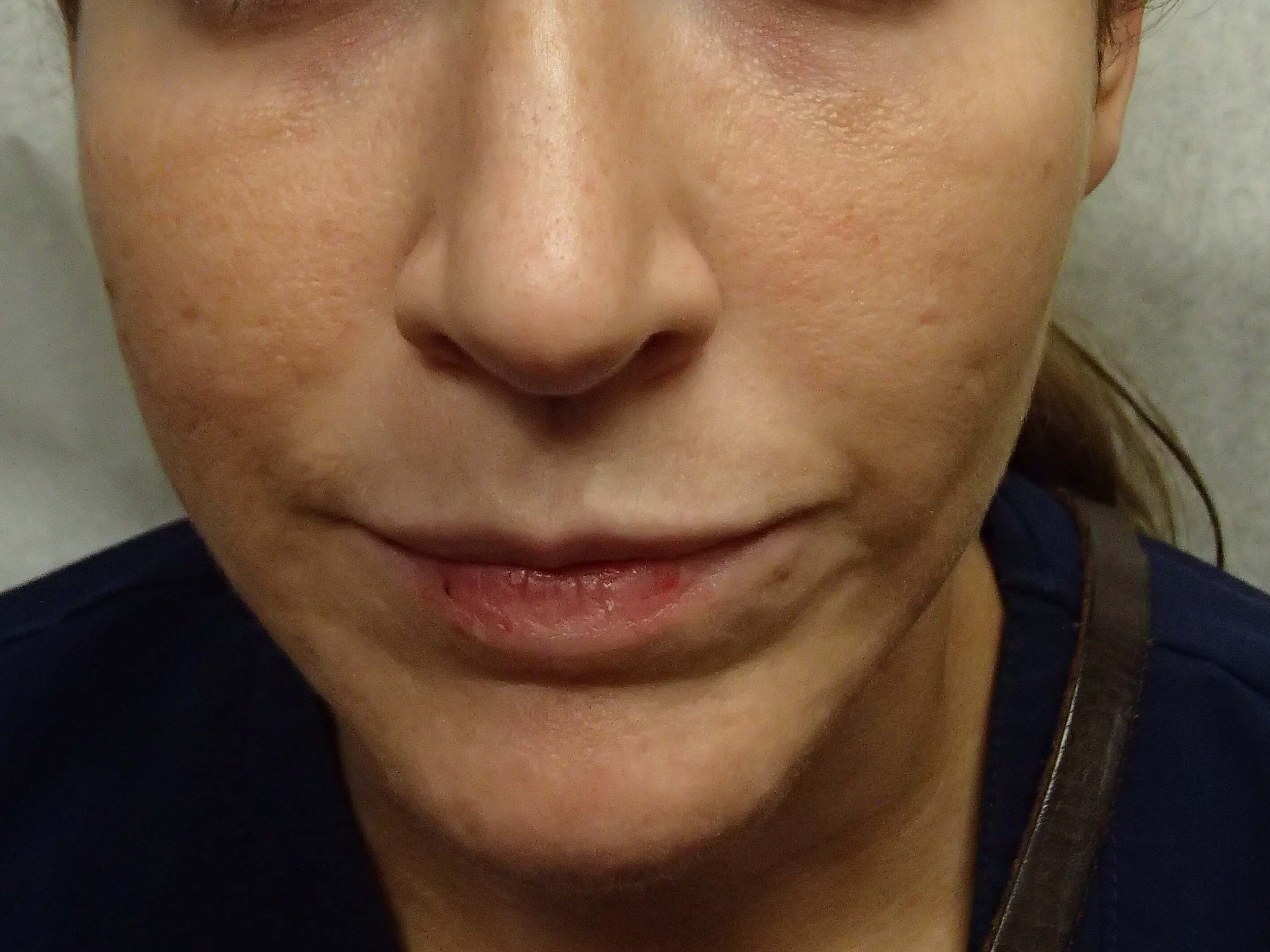 Botox to Masseters After