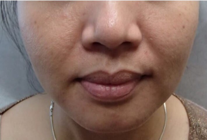 Botox to Masseters Before