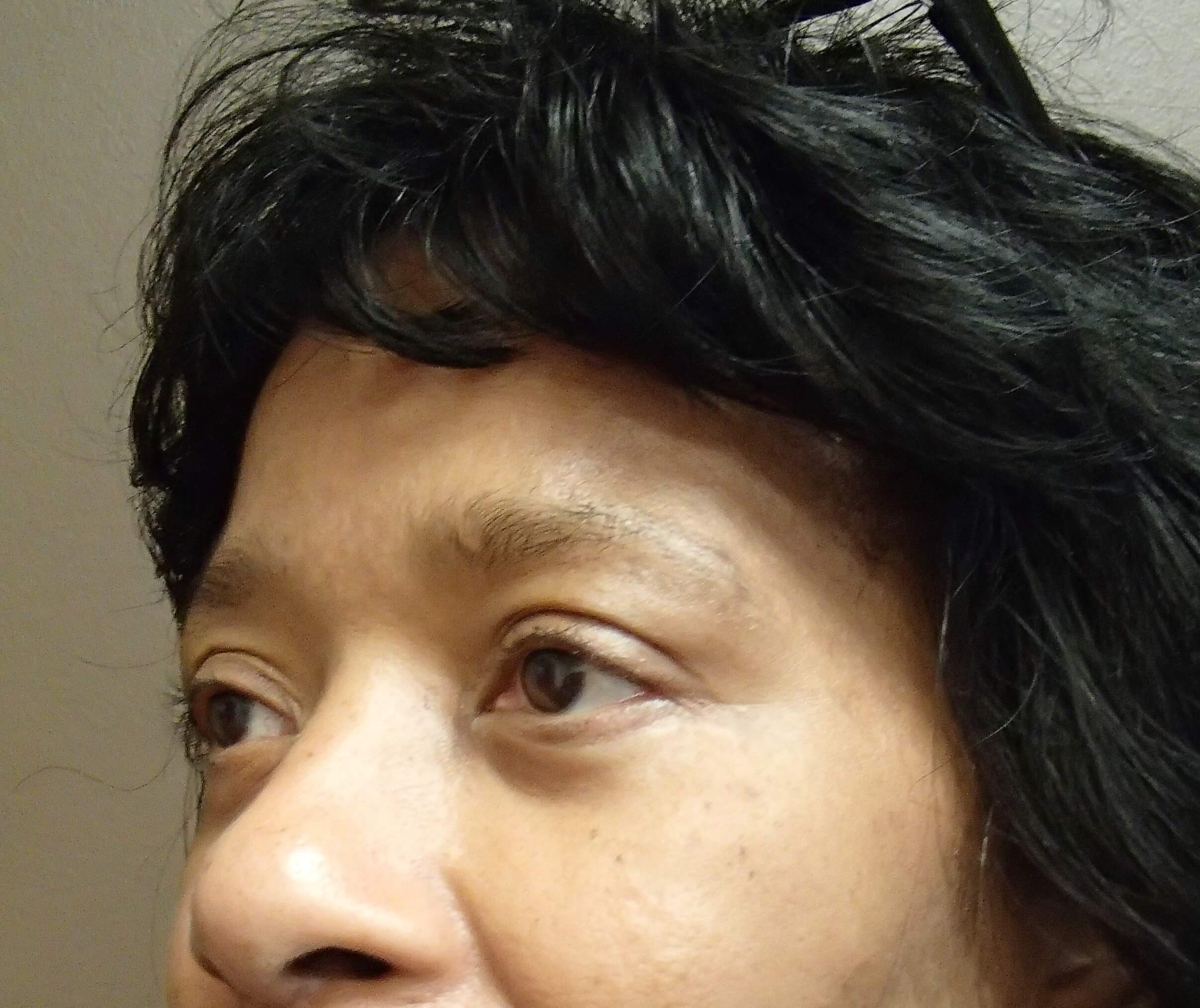 Browlift w/ Eyelid Lift After