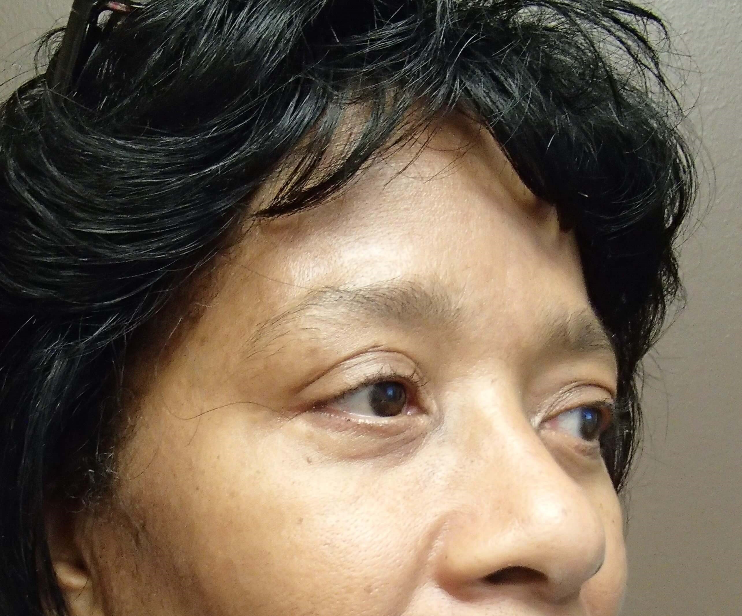 Browlift w/ Eyelid Lift After
