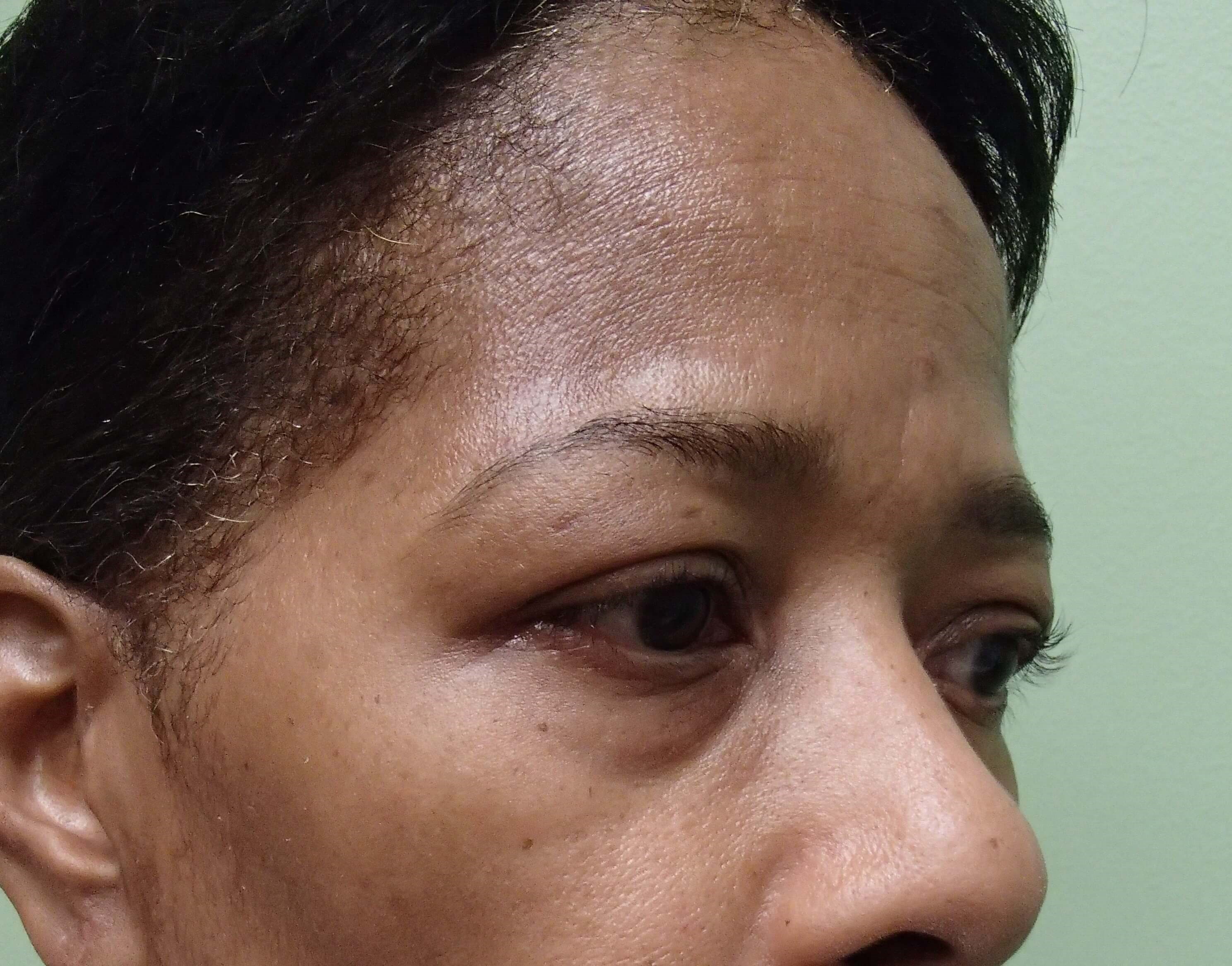 Browlift w/ Eyelid Lift Before
