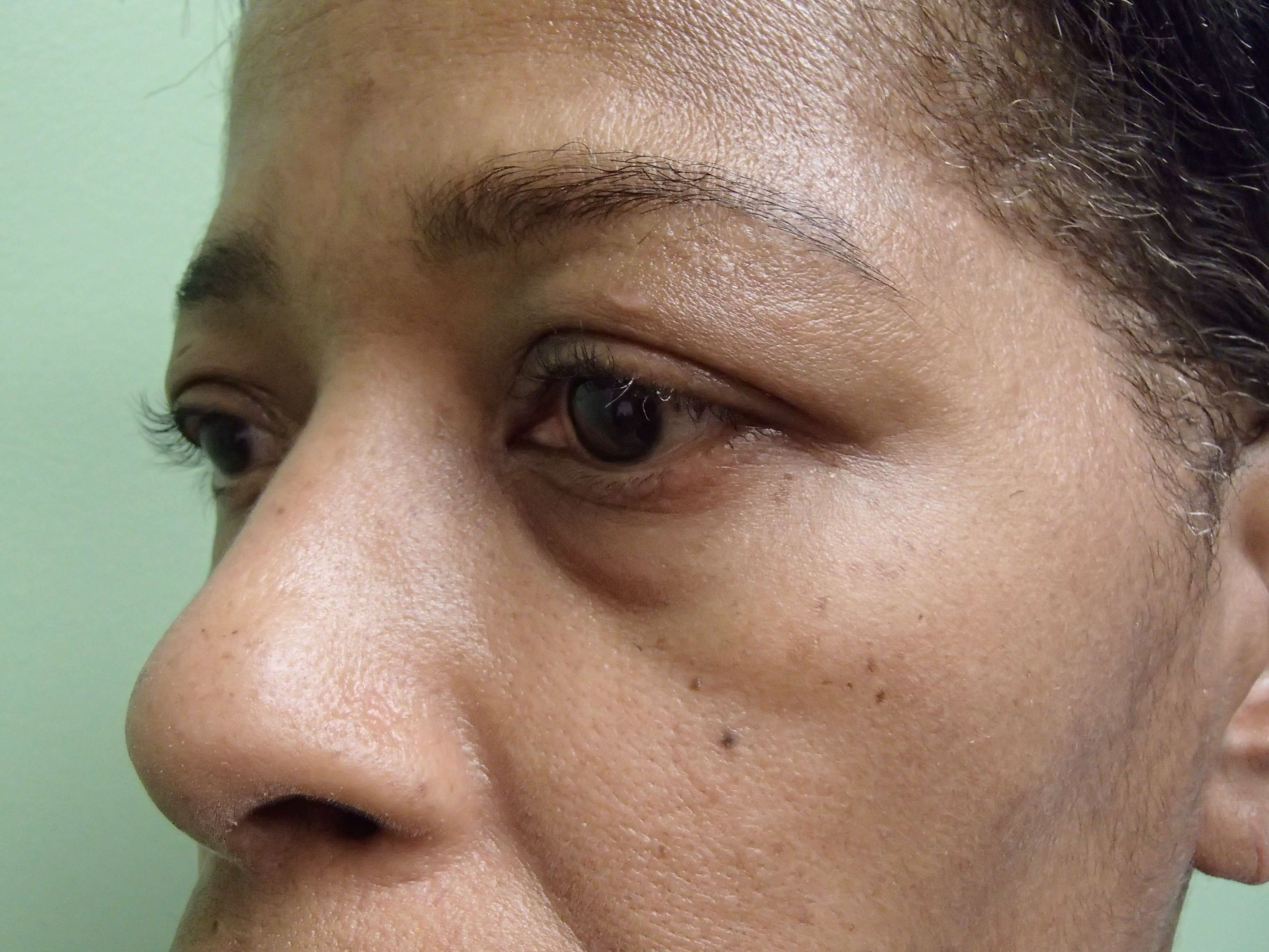 Browlift w/ Eyelid Lift Before