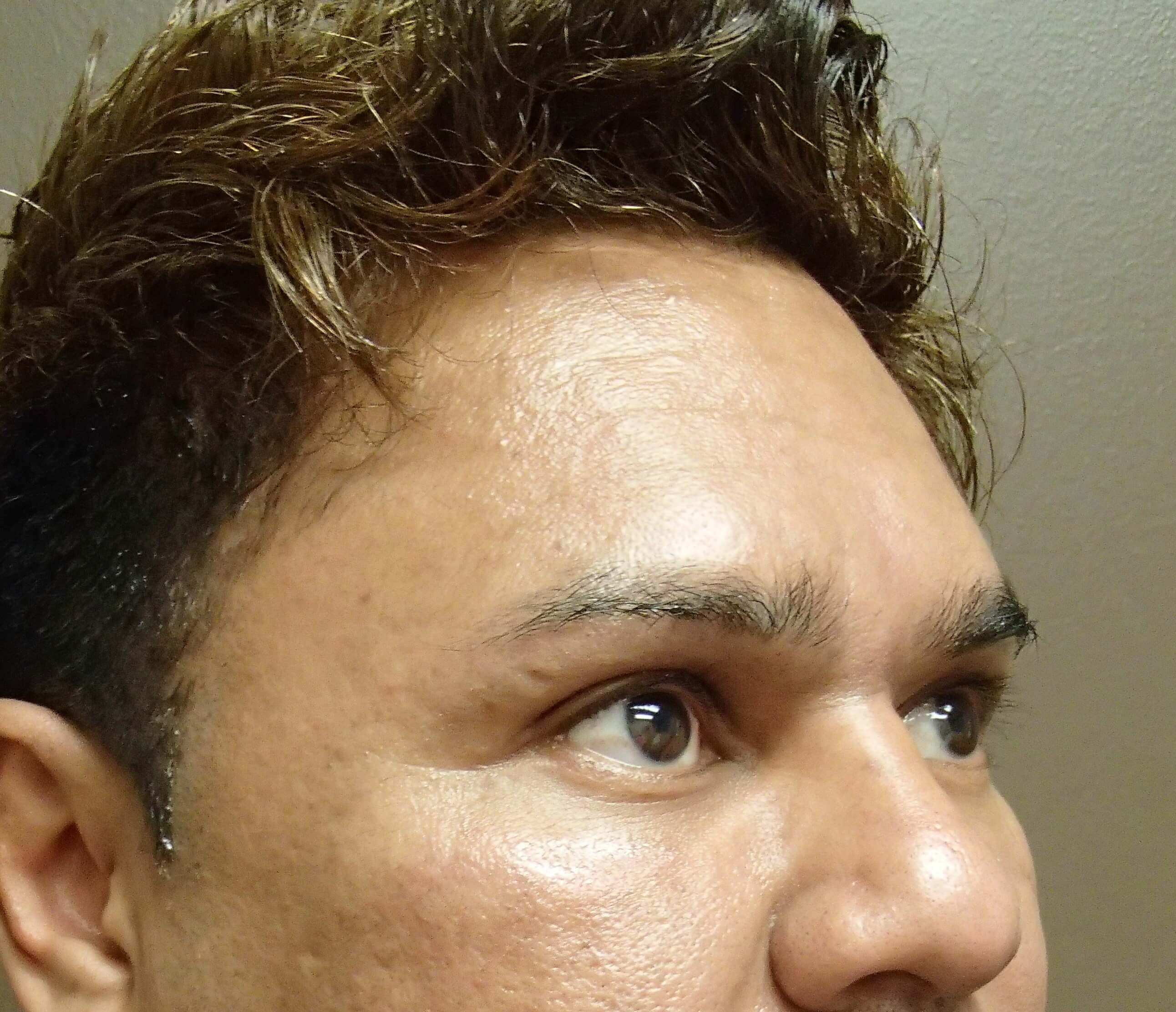 Browlift After