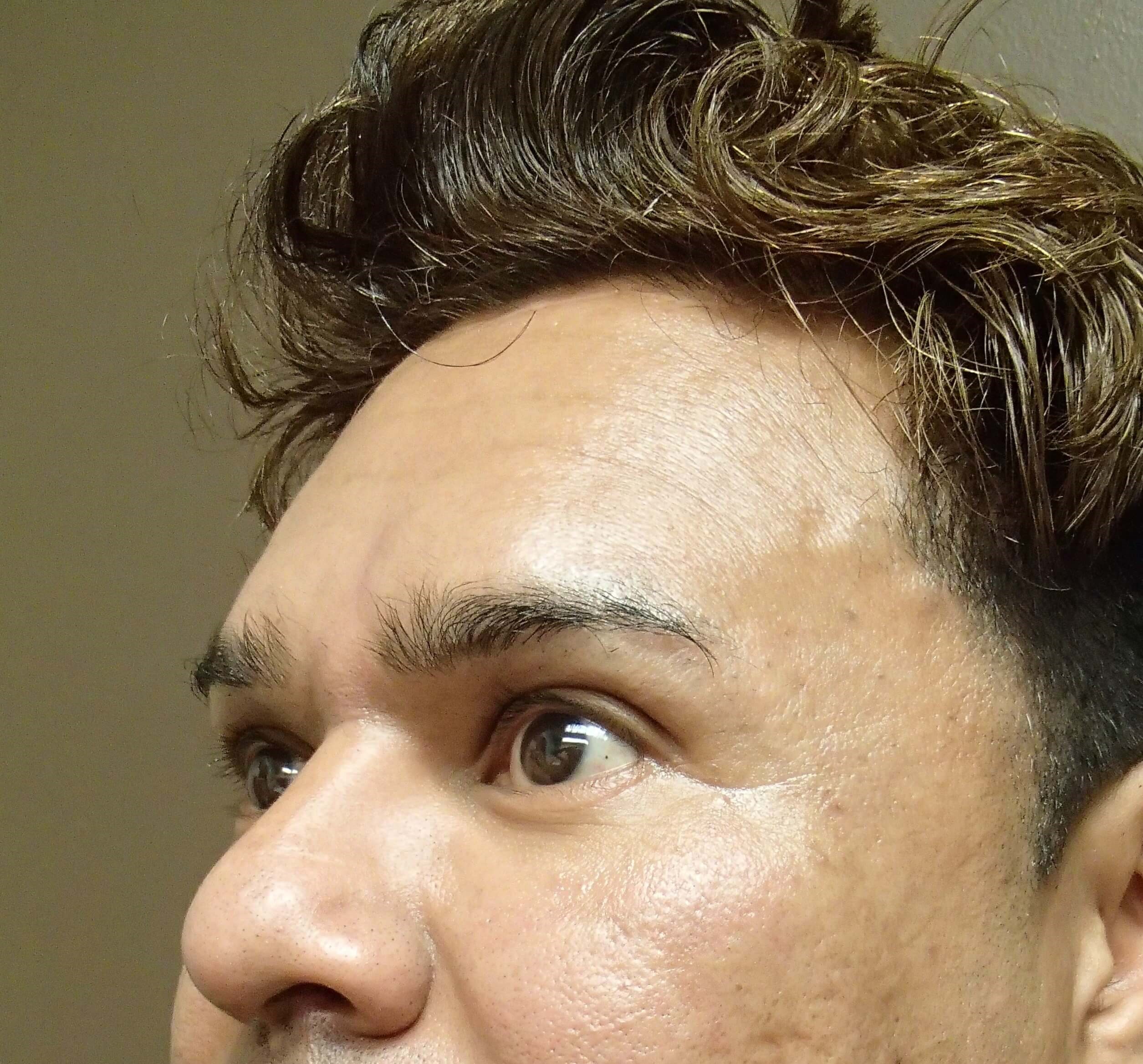 Browlift After