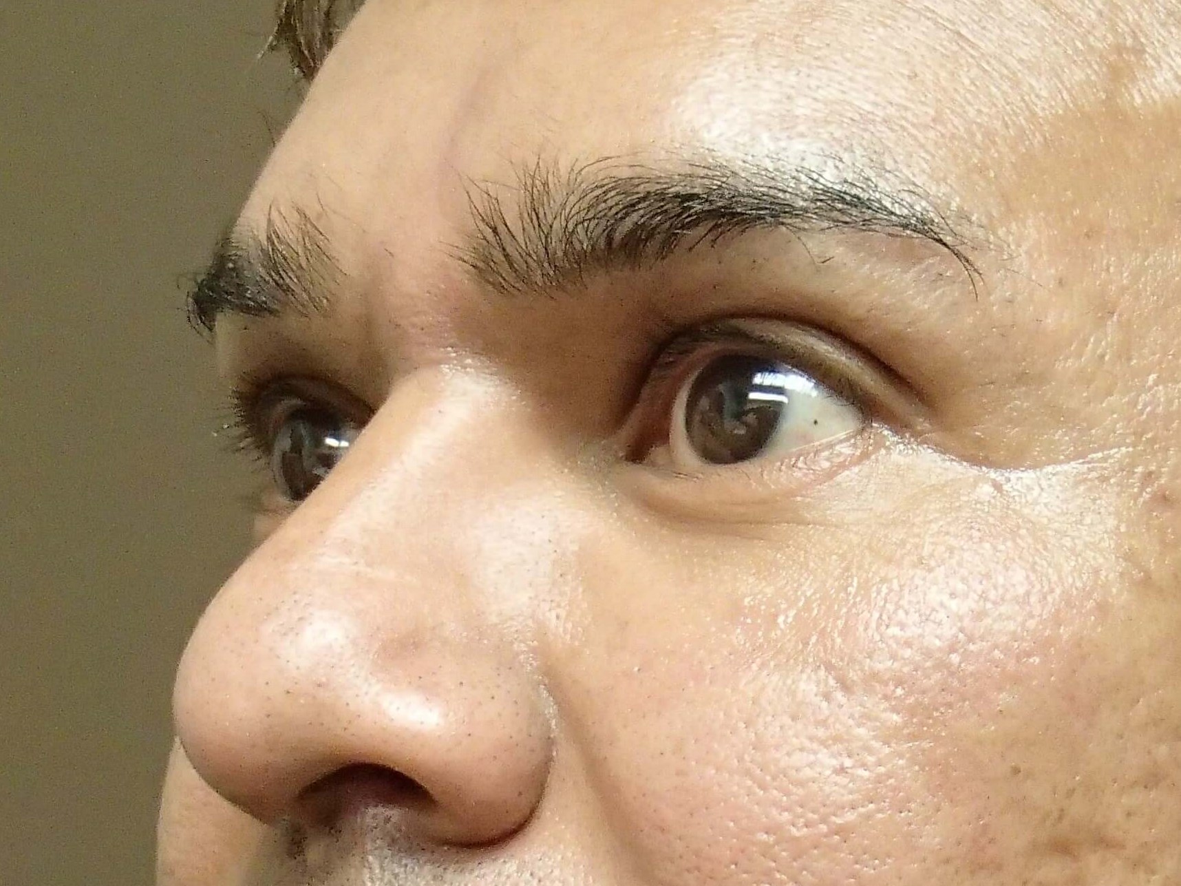 Browlift After