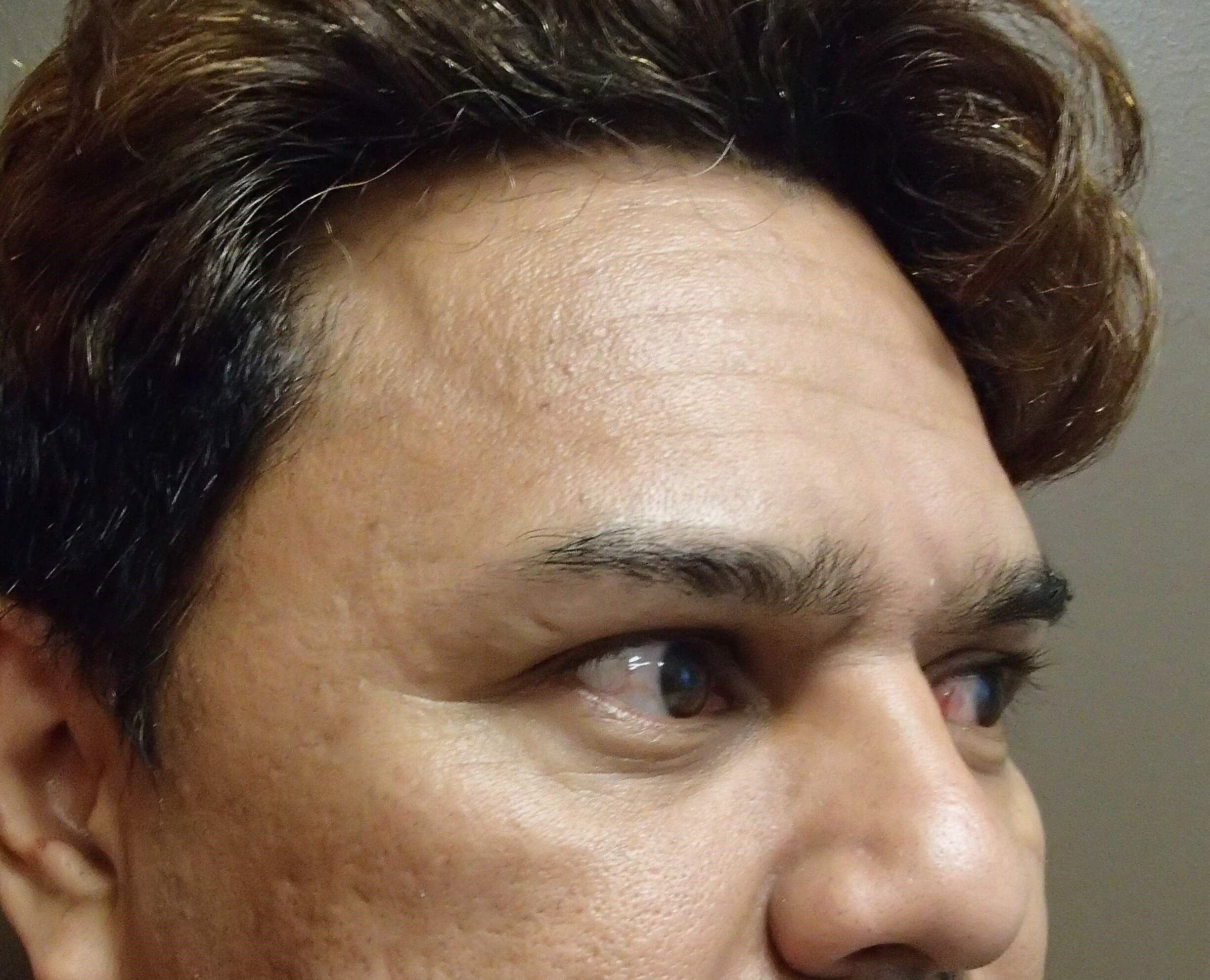 Browlift Before