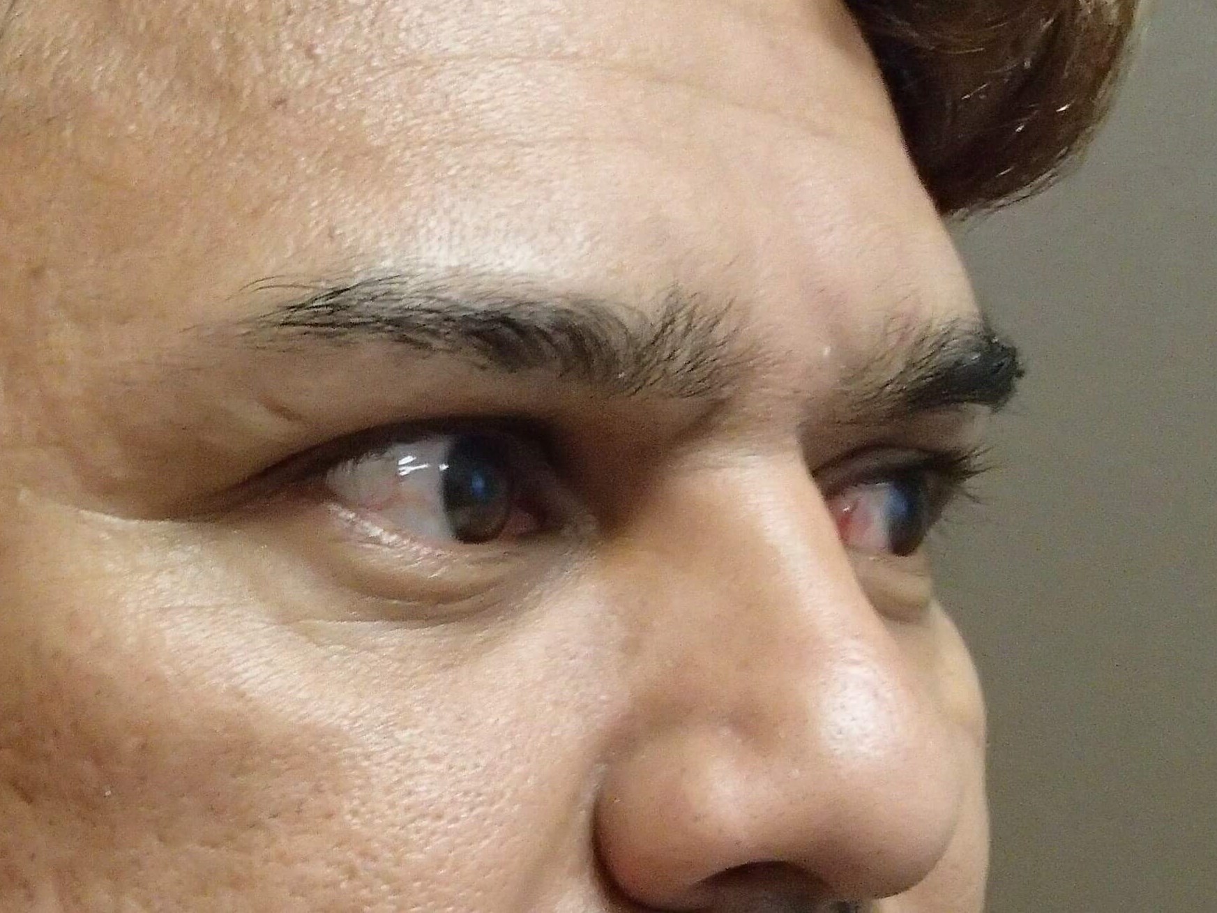Browlift Before