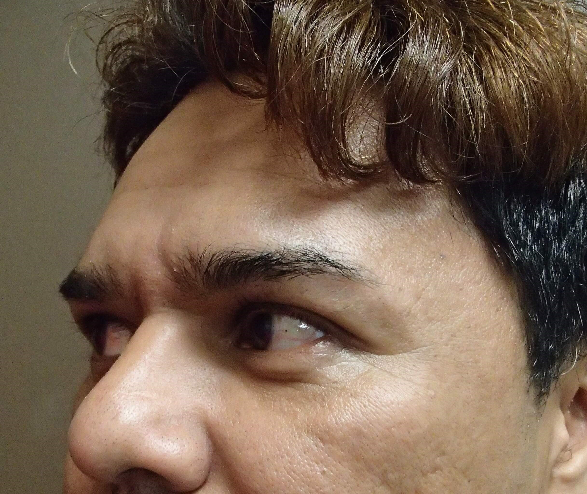 Browlift Before